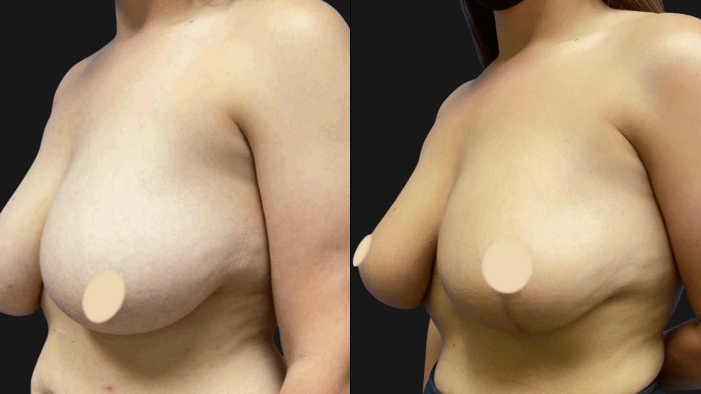Side-by-side comparison of a woman’s topless upper body before and after a cosmetic procedure, with black background.