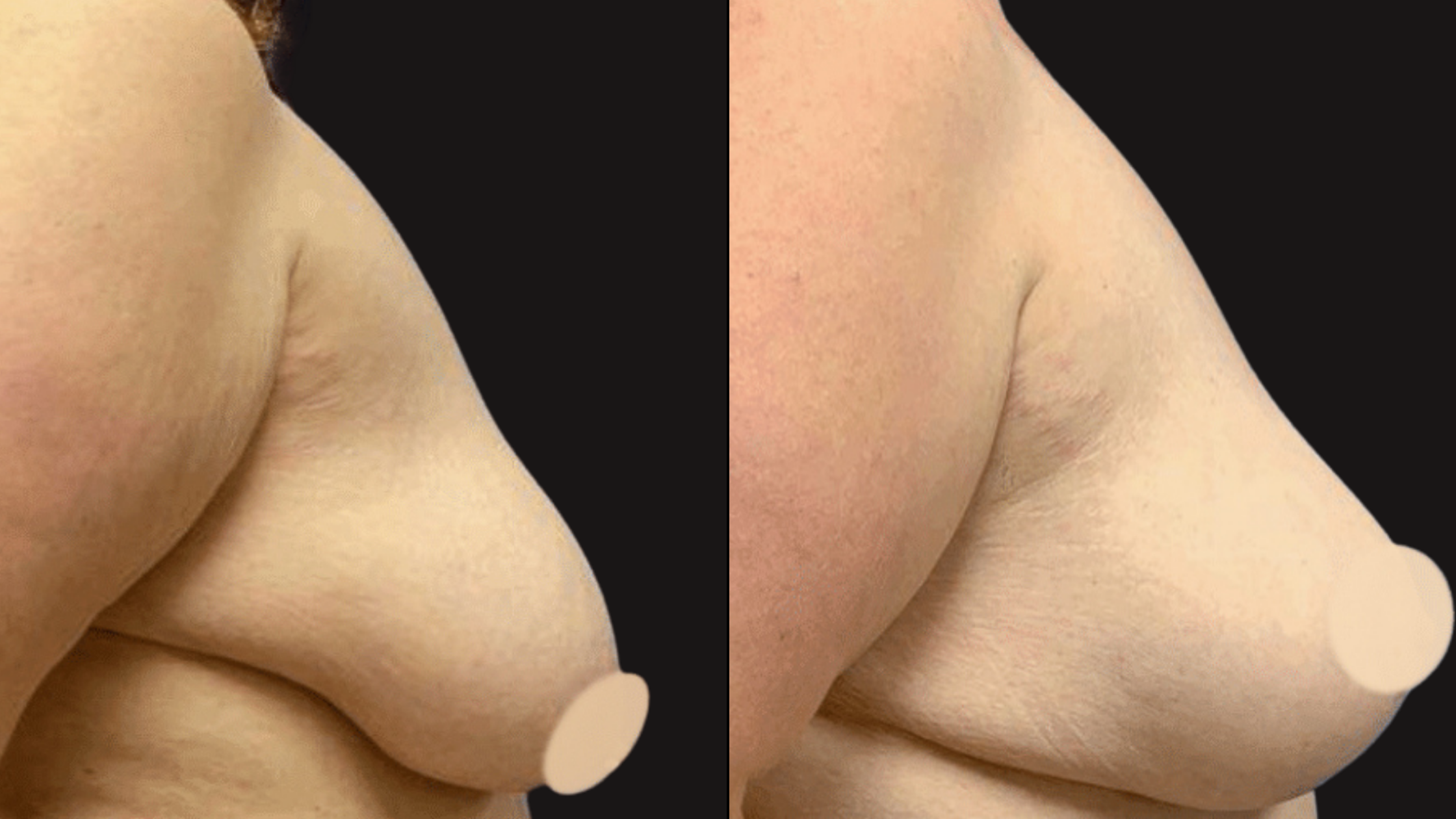 Comparison of a person's shoulder and arm before and after skin treatment, showing smoother skin and reduced cellulite in the after image.