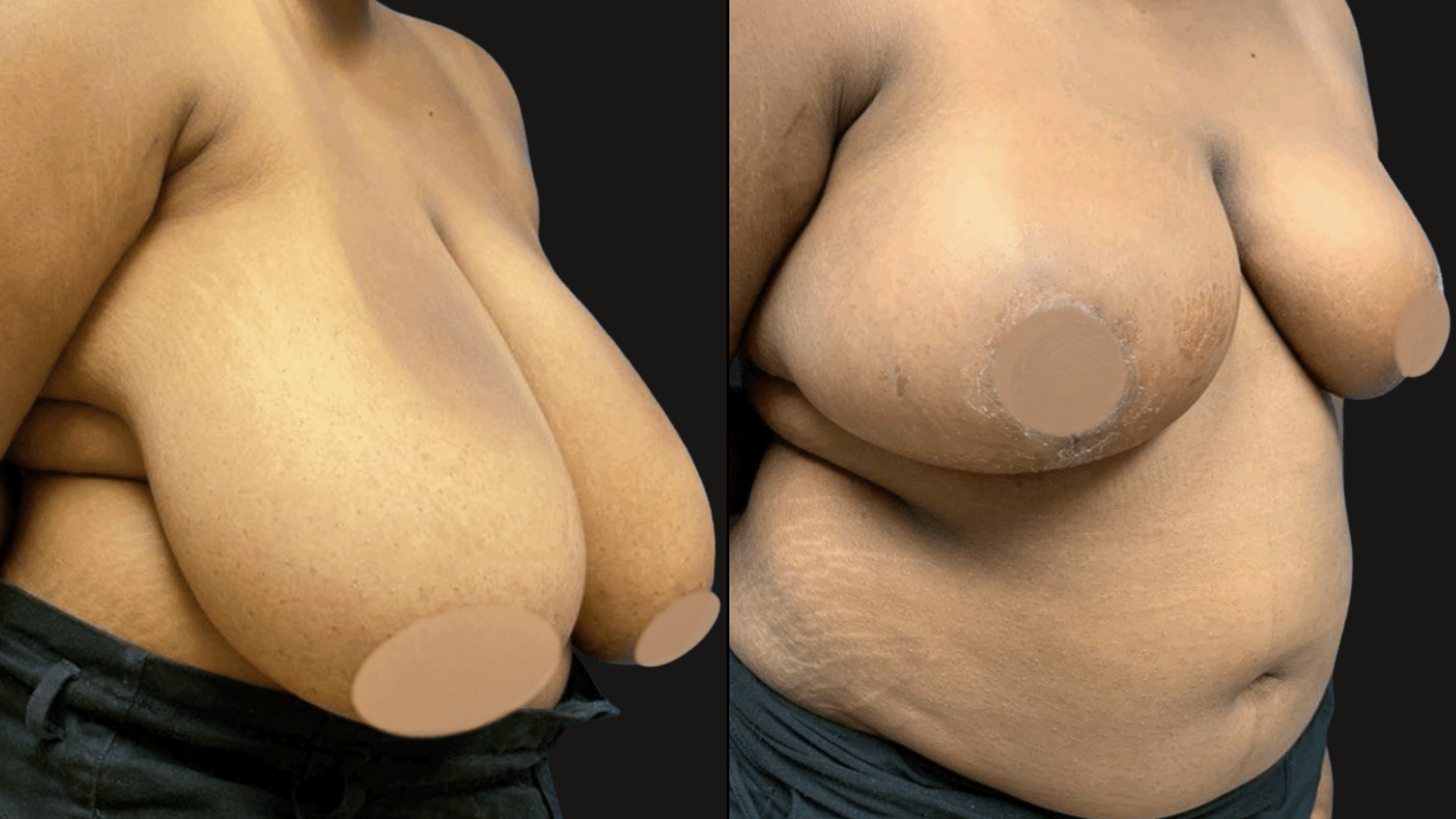 Close-up of a person's chest and abdomen with acne scars, showing the left and right sides of the body, against a black background.