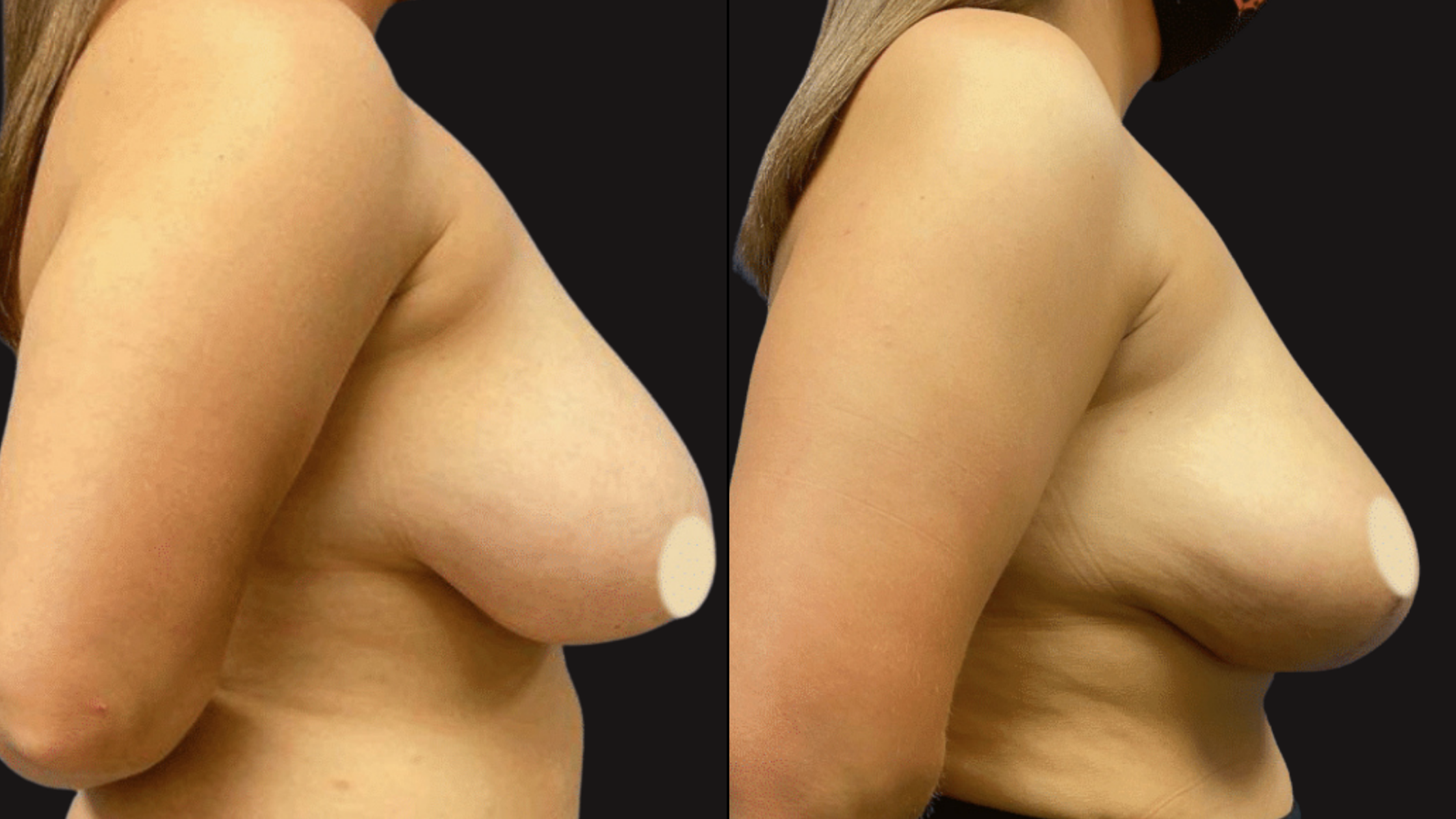 Comparison of two images showing a female torso with focus on breast area, with one image on the left and the other on the right, against a black background.