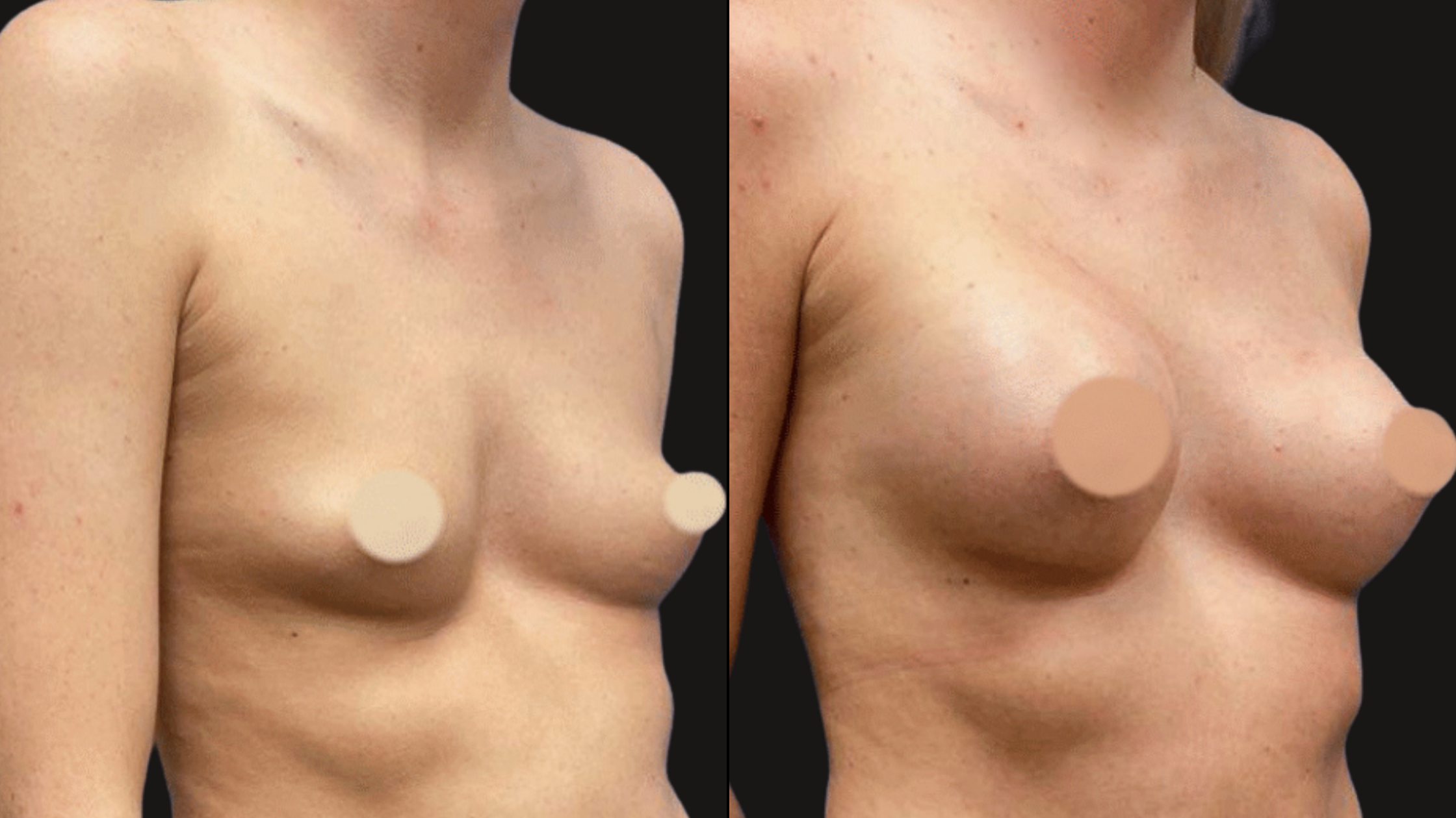 Side-by-side comparison showing before and after images of a woman's torso, highlighting breast augmentation results with increased size and volume in the after image.