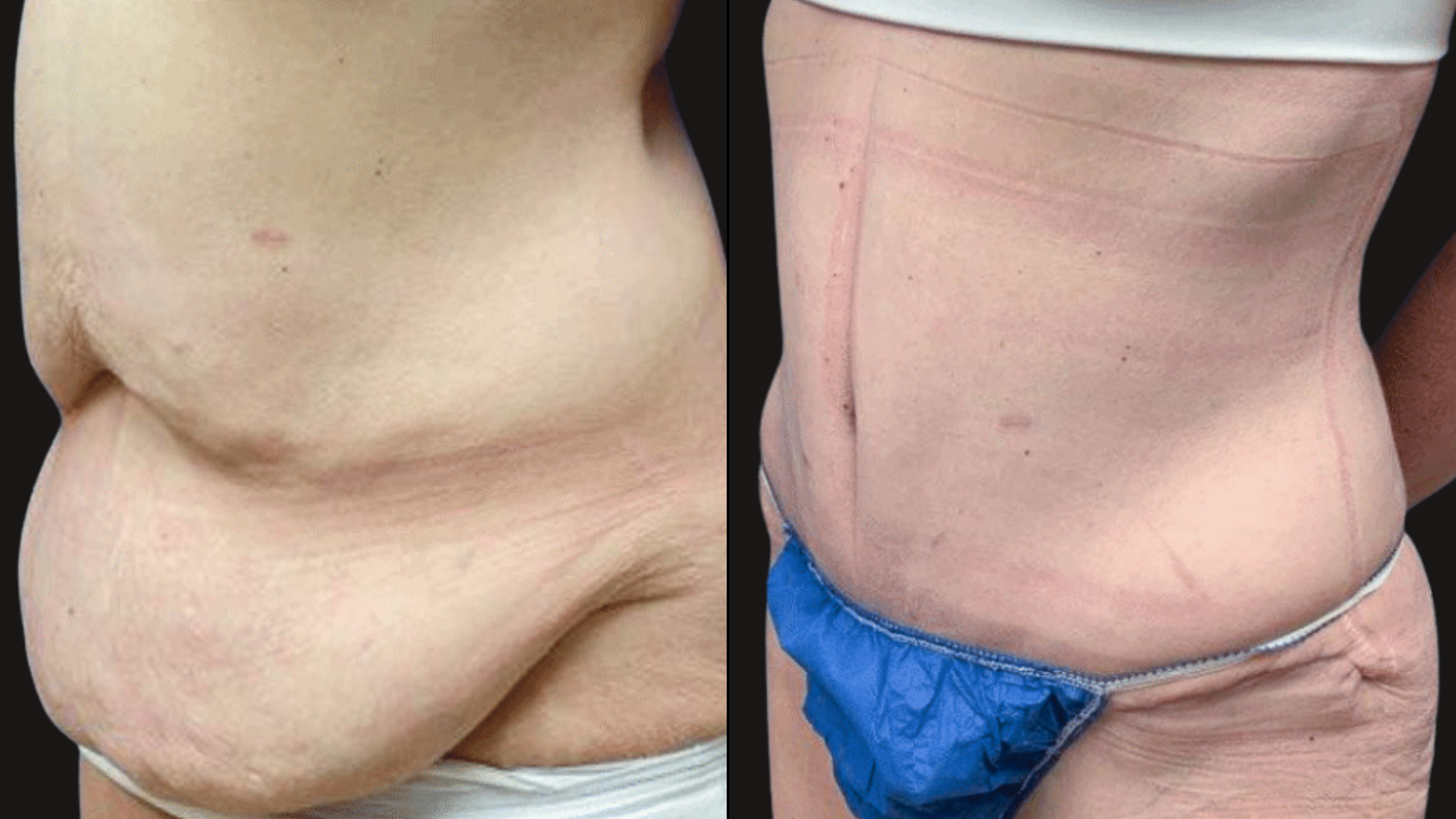 Comparison of a person's torso before and after a body transformation or surgical procedure. The left side shows excess skin and fat, while the right side shows a more toned and defined abdomen with visible surgical scars.