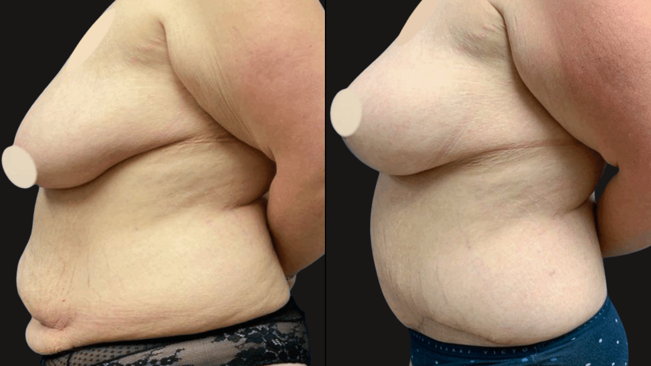 Comparison of a person's side torso, showing weight loss progress before (left) and after (right).