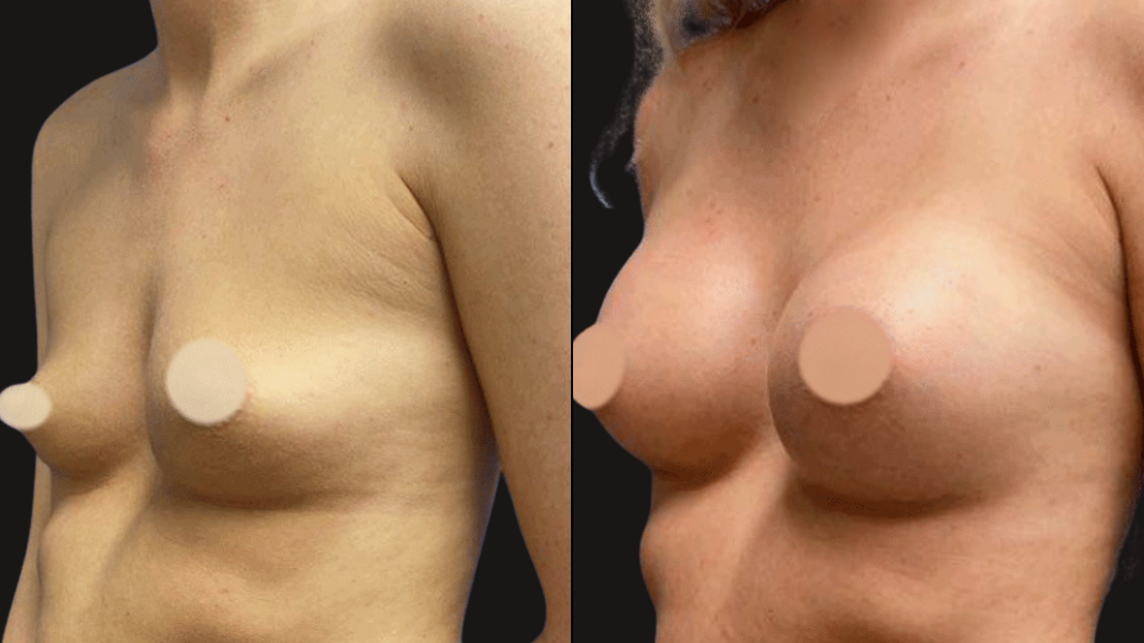 A side-by-side comparison of a woman's bare breasts before and after a cosmetic procedure, with the left showing smaller breasts and the right showing larger, fuller breasts.