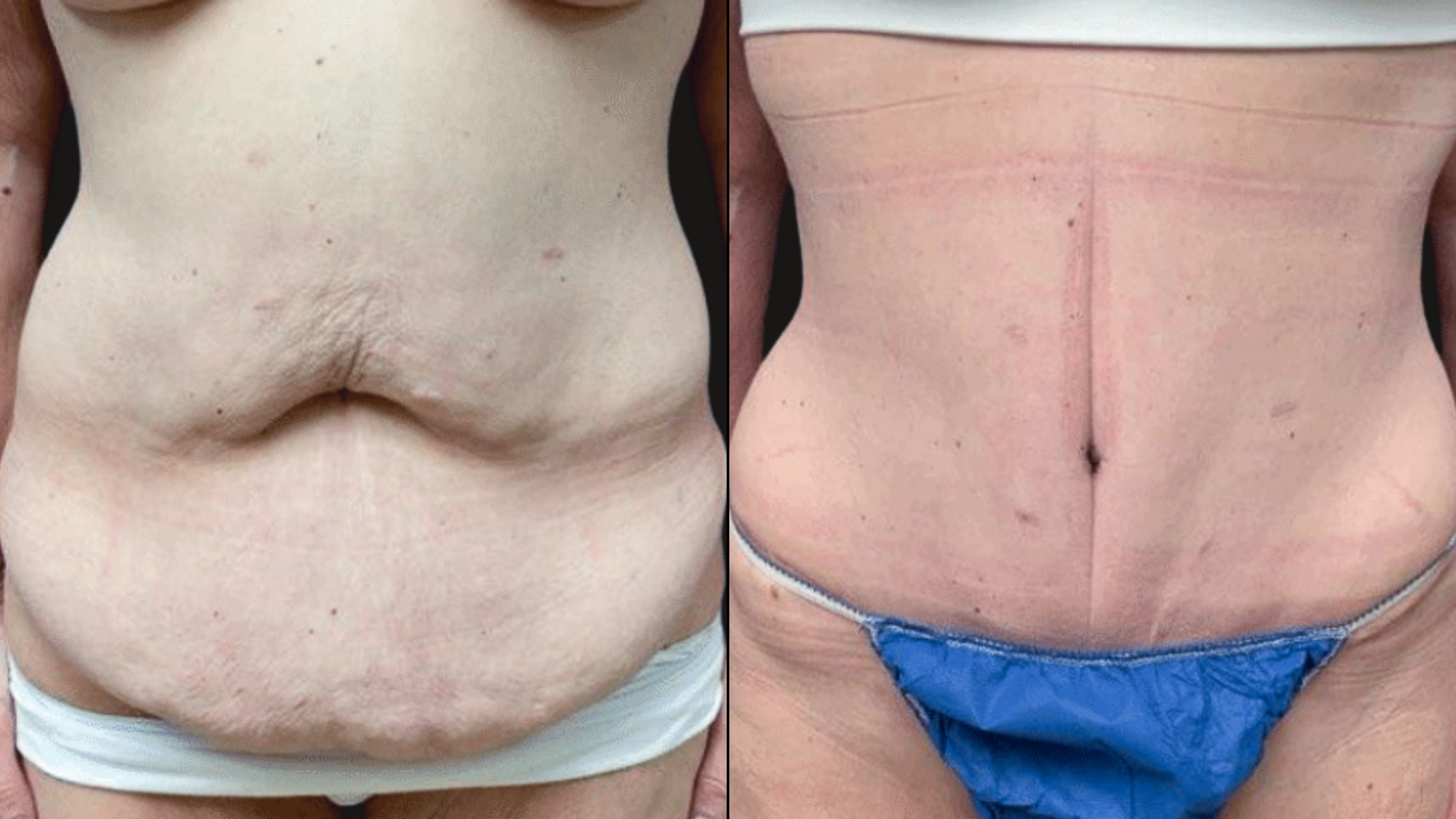 Comparison of abdominal appearance before and after skin tightening or cosmetic procedure. The left side shows loose, sagging skin, while the right side shows smoother, tighter skin with visible stretch marks.