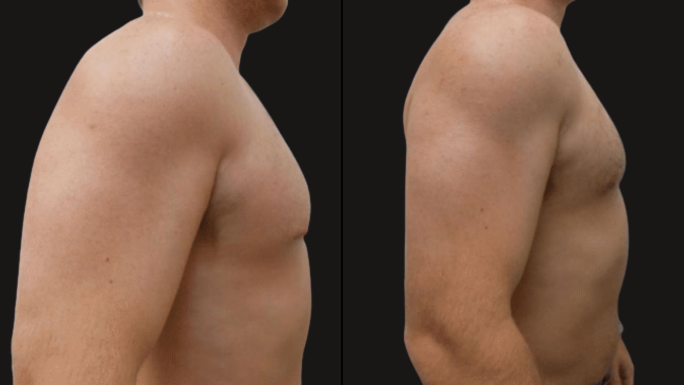 Comparison of a male torso before and after a cosmetic procedure, showing slight changes in muscle mass and skin appearance on the arm and chest.