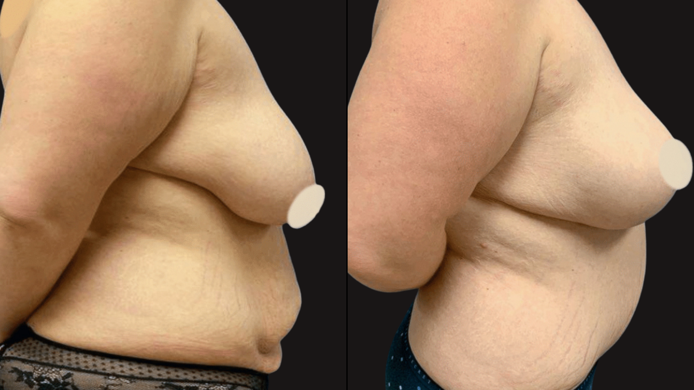 Side-by-side comparison of a person's torso showing the before and after of a skin tightening procedure, with visible skin improvement on the right side, against a black background.