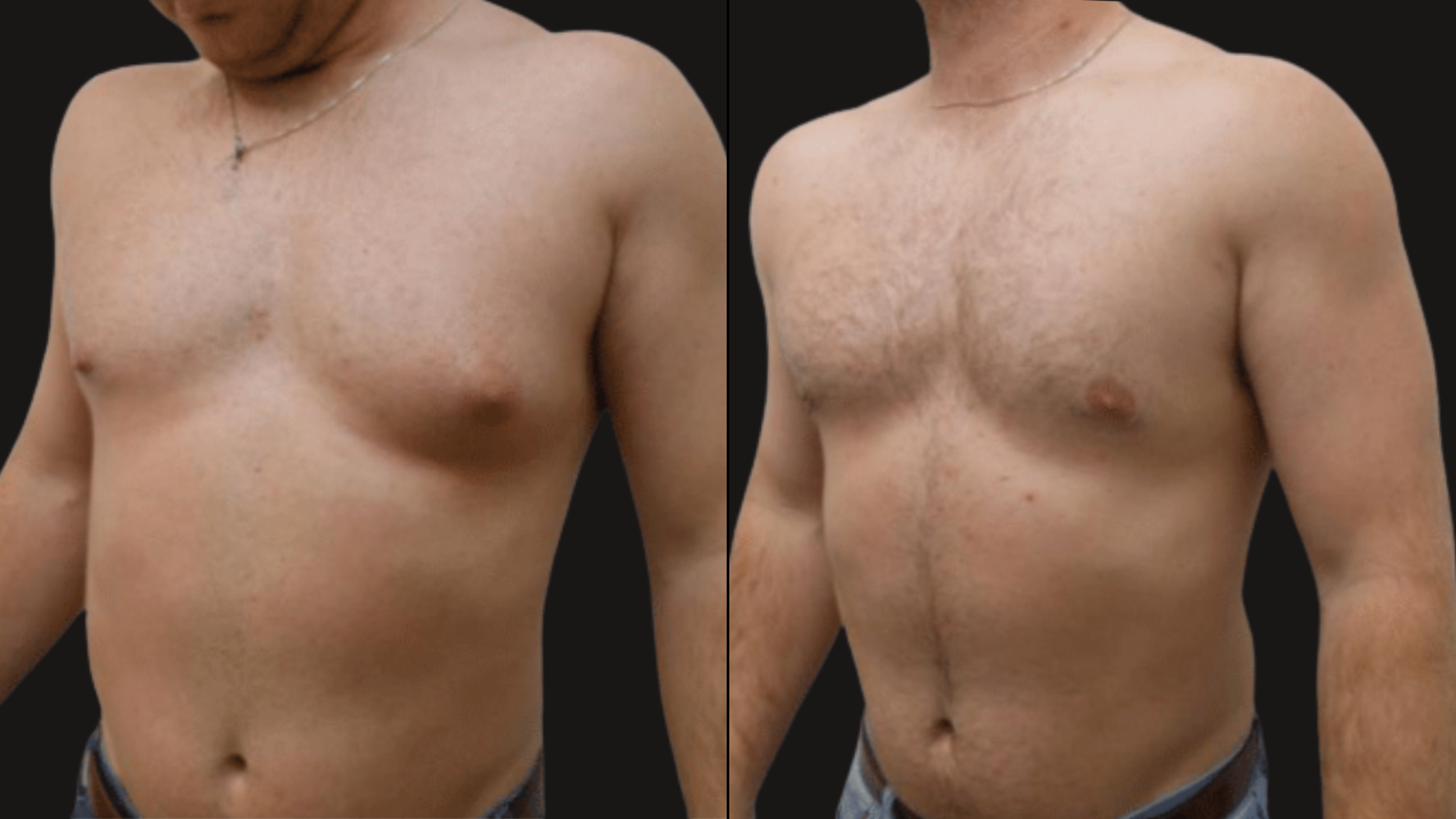 Comparison of a man's upper torso before and after a cosmetic or medical procedure, with changes in skin texture, color, and chest appearance.