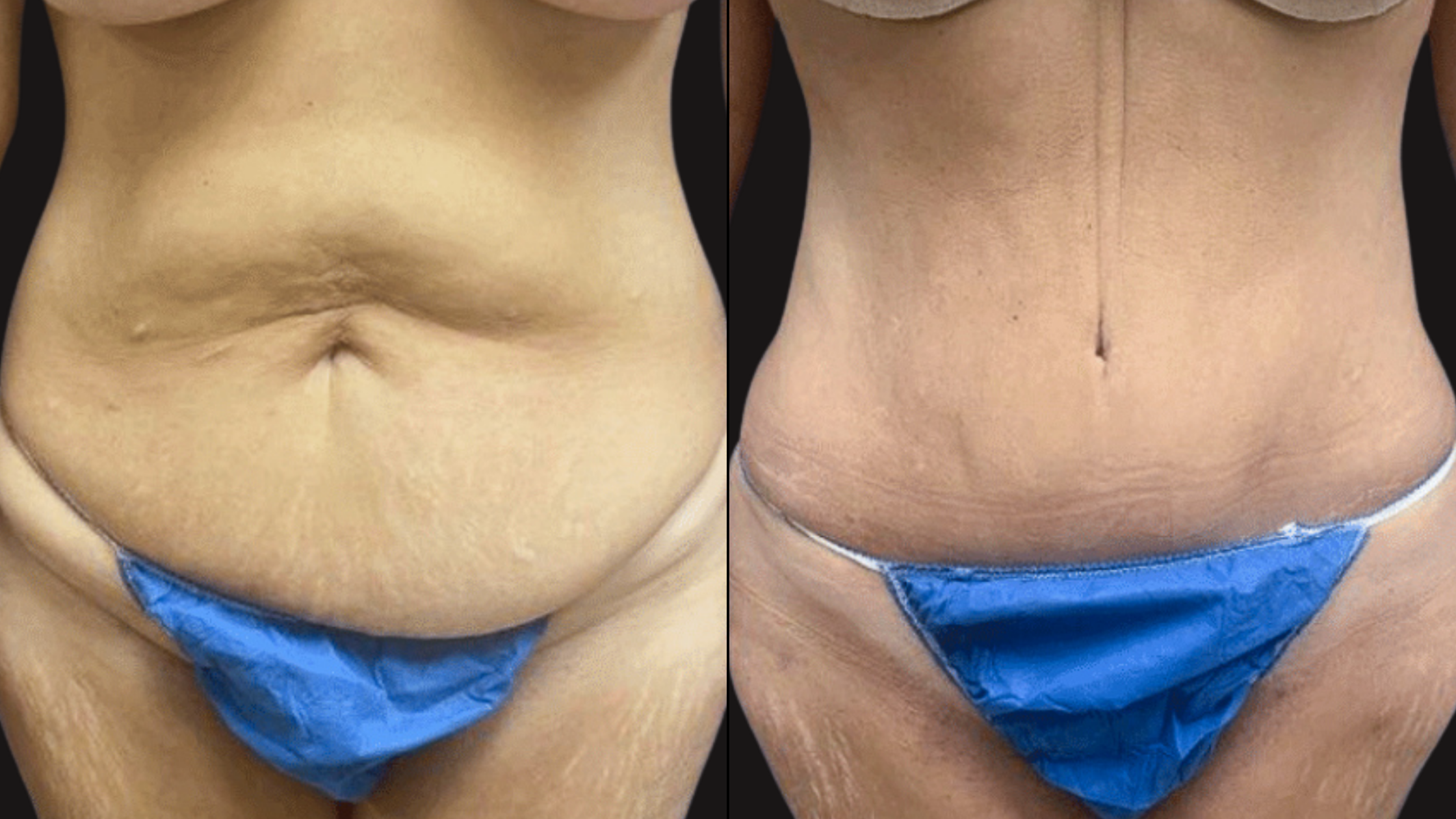 A side-by-side comparison of a woman's abdomen before and after a skin tightening procedure, with visible changes in skin firmness and texture.