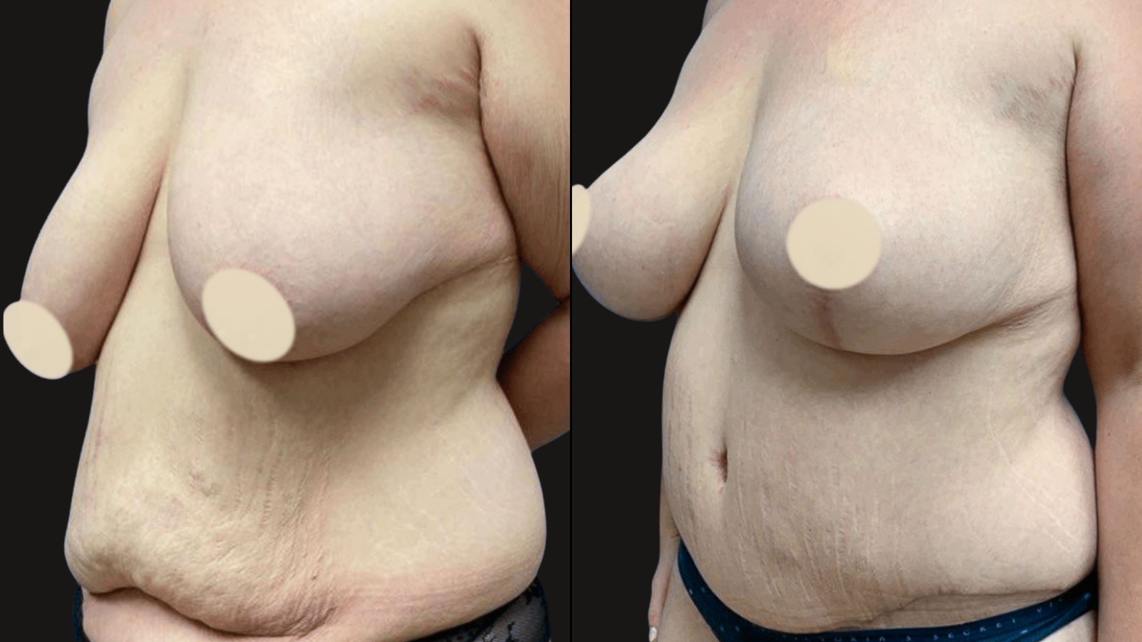 Close-up of a topless elderly woman with large breasts and visible stretch marks, wearing underwear, against a black background.