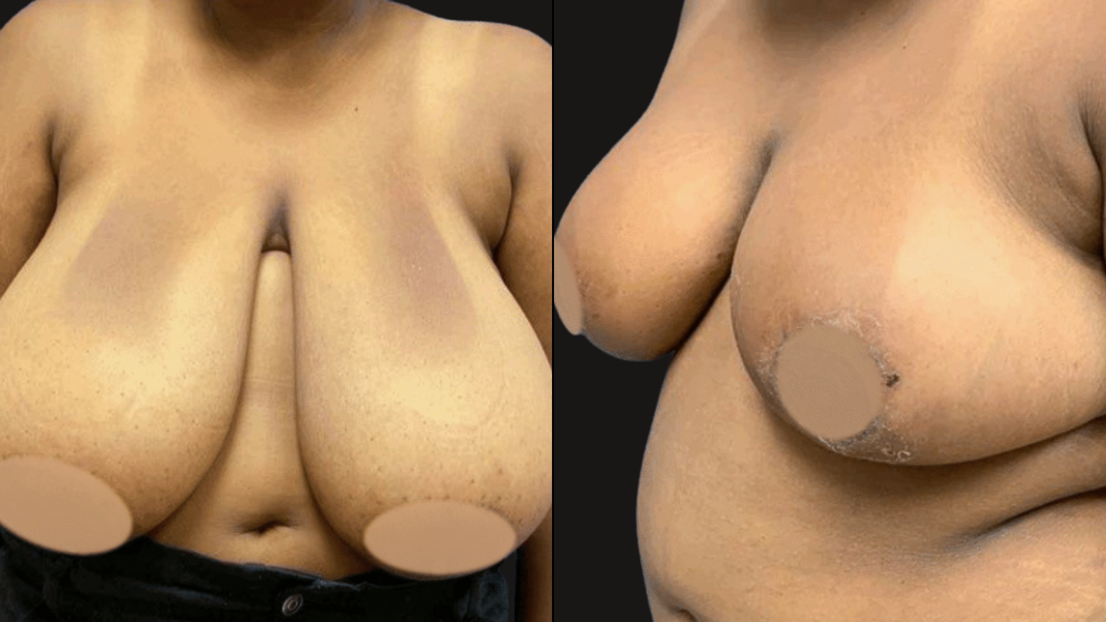 A side-by-side comparison of a person's bare chest and stomach, showing the chest from a front view and the stomach from a side view, with the nipples censored.