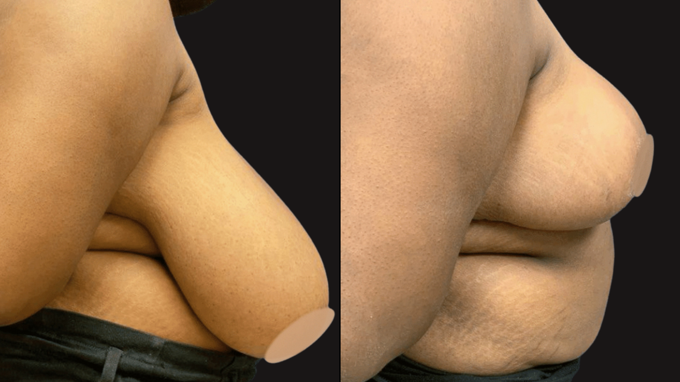Close-up comparison of two side profiles of a person's face and cheek, showing different skin textures and features, set against a black background.