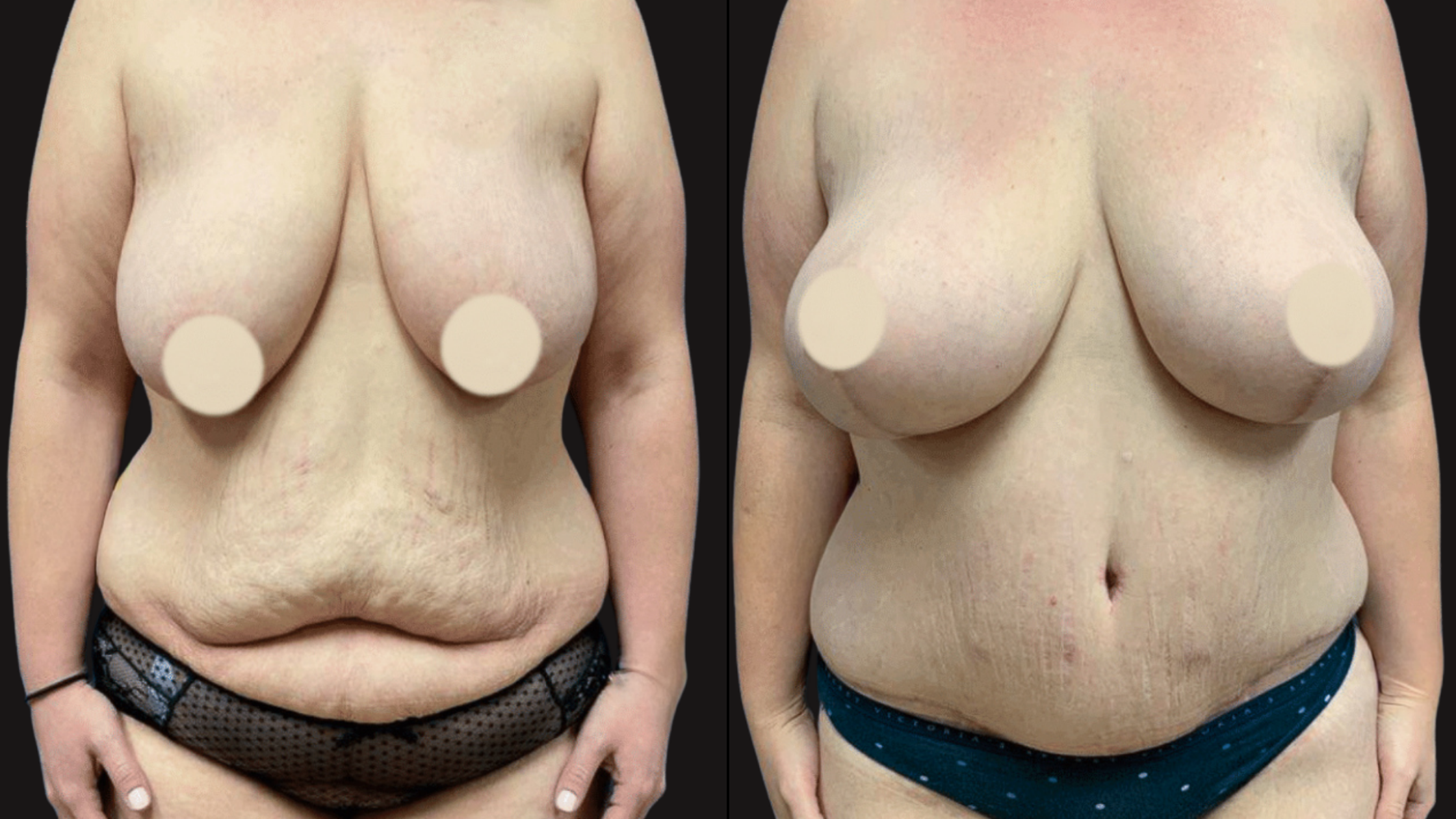 Side-by-side comparison of a woman's torso before and after weight loss. The left shows extra skin and sagging, while the right shows a more toned appearance with less loose skin.