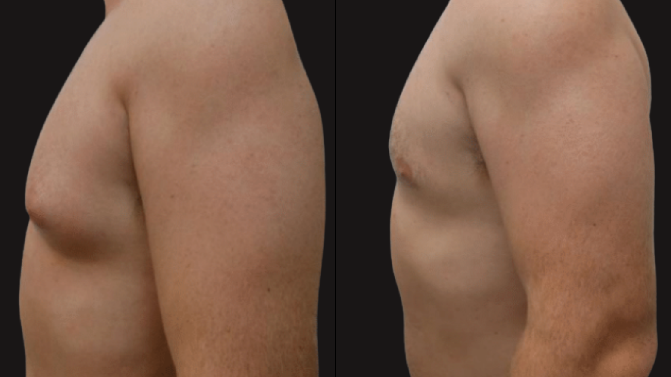 Comparison of a person's back and arm before and after a cosmetic procedure showing minimal changes.
