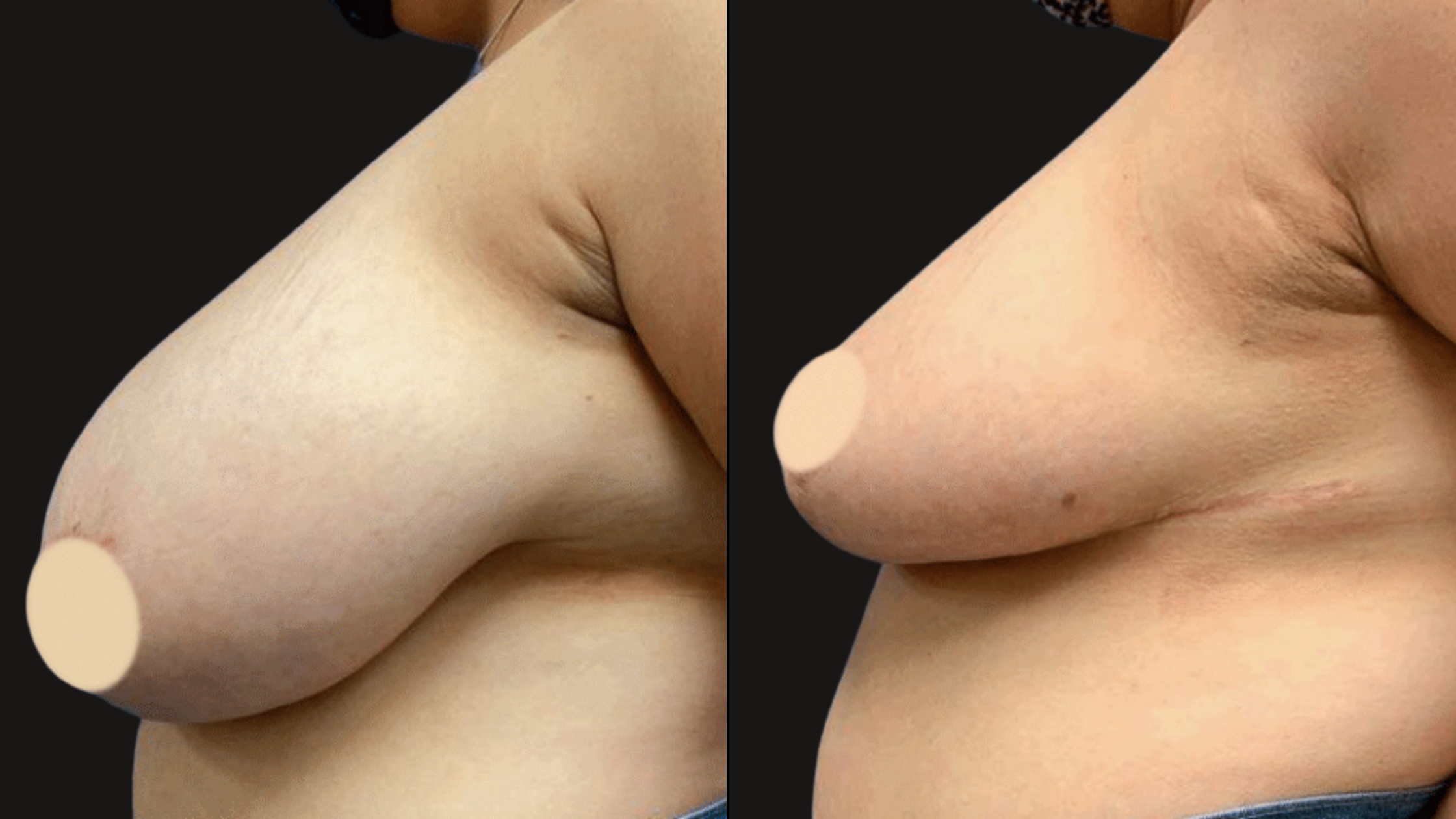 Close-up of a woman's upper body, showing her shoulder, breast, and part of her arm against a black background.