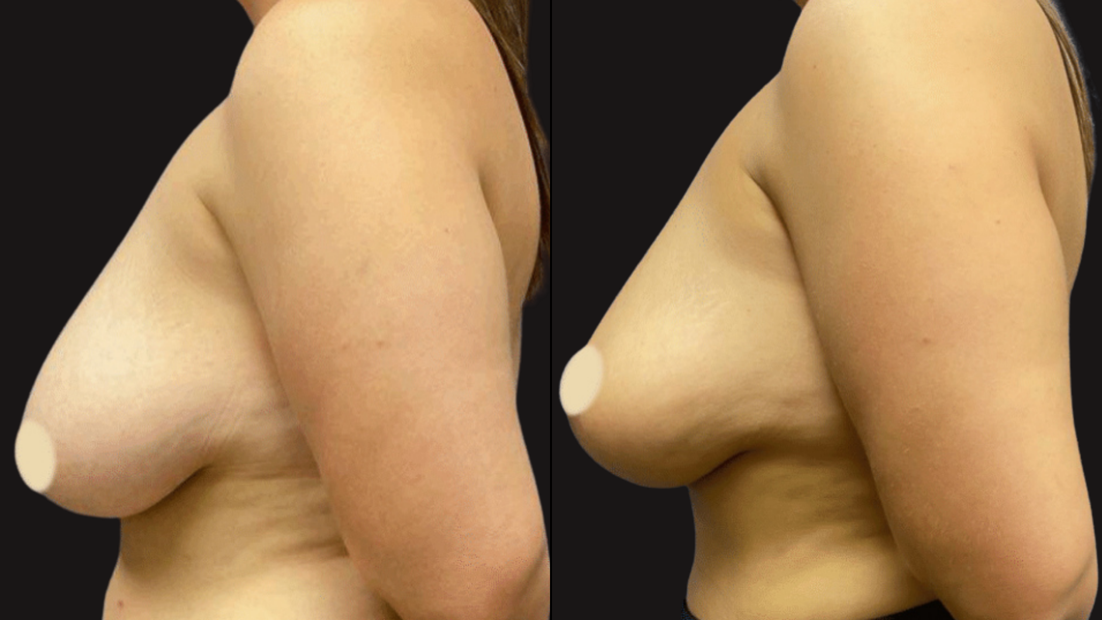 Close-up of a woman's breasts and shoulder, with a black background, showing side and frontal views.