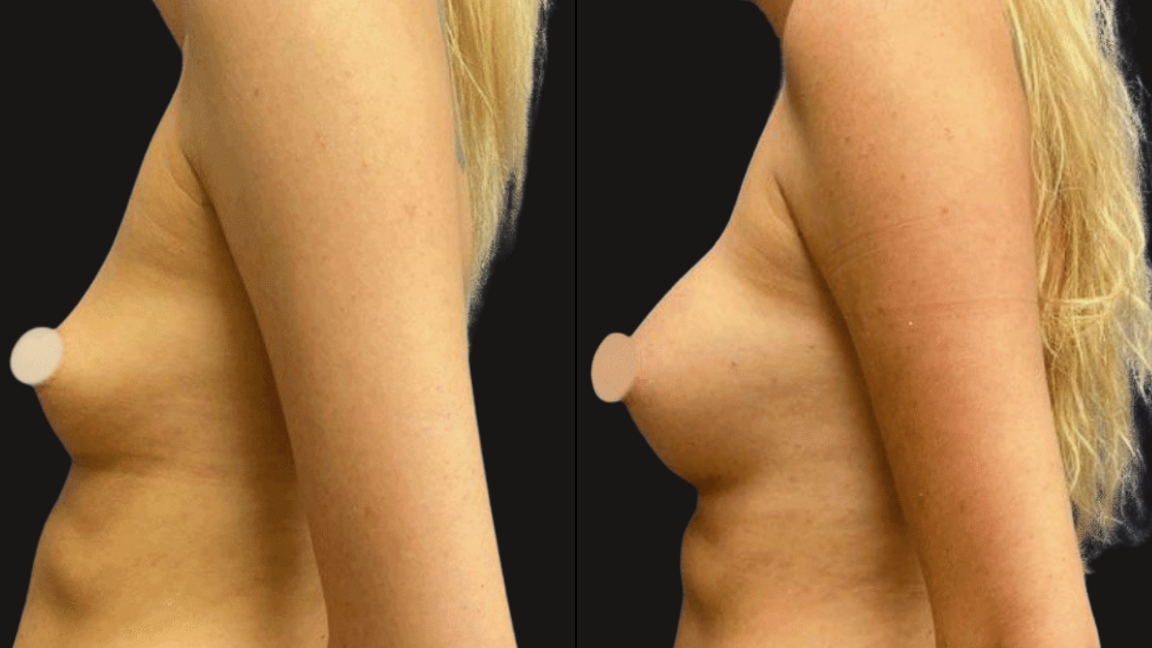 Side-by-side comparison of a woman’s bare upper body, focusing on breast size, with a black background.