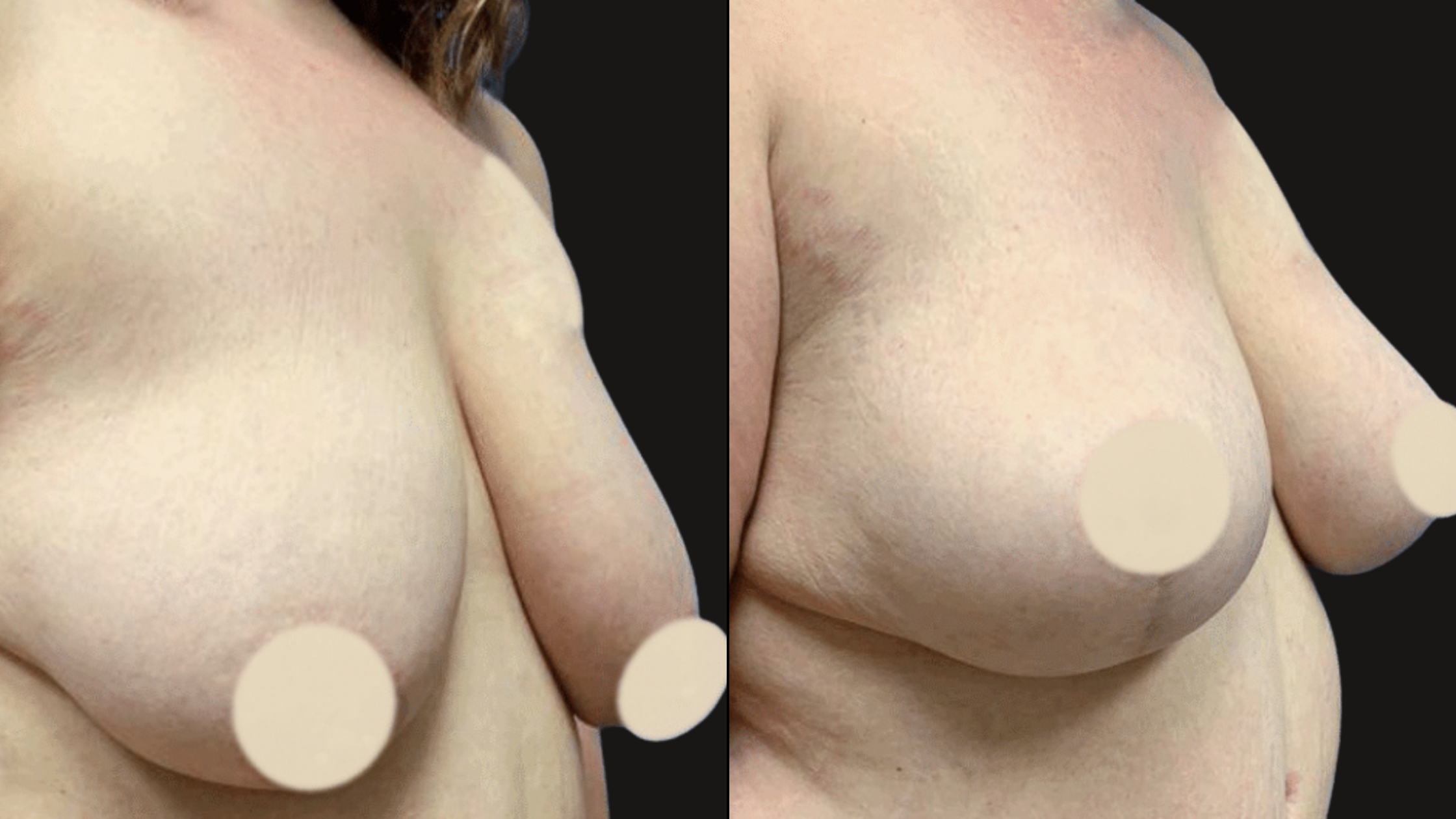 Comparison of two close-up images of a person's bare chest, focusing on the breast area, with black background and censored nipples.