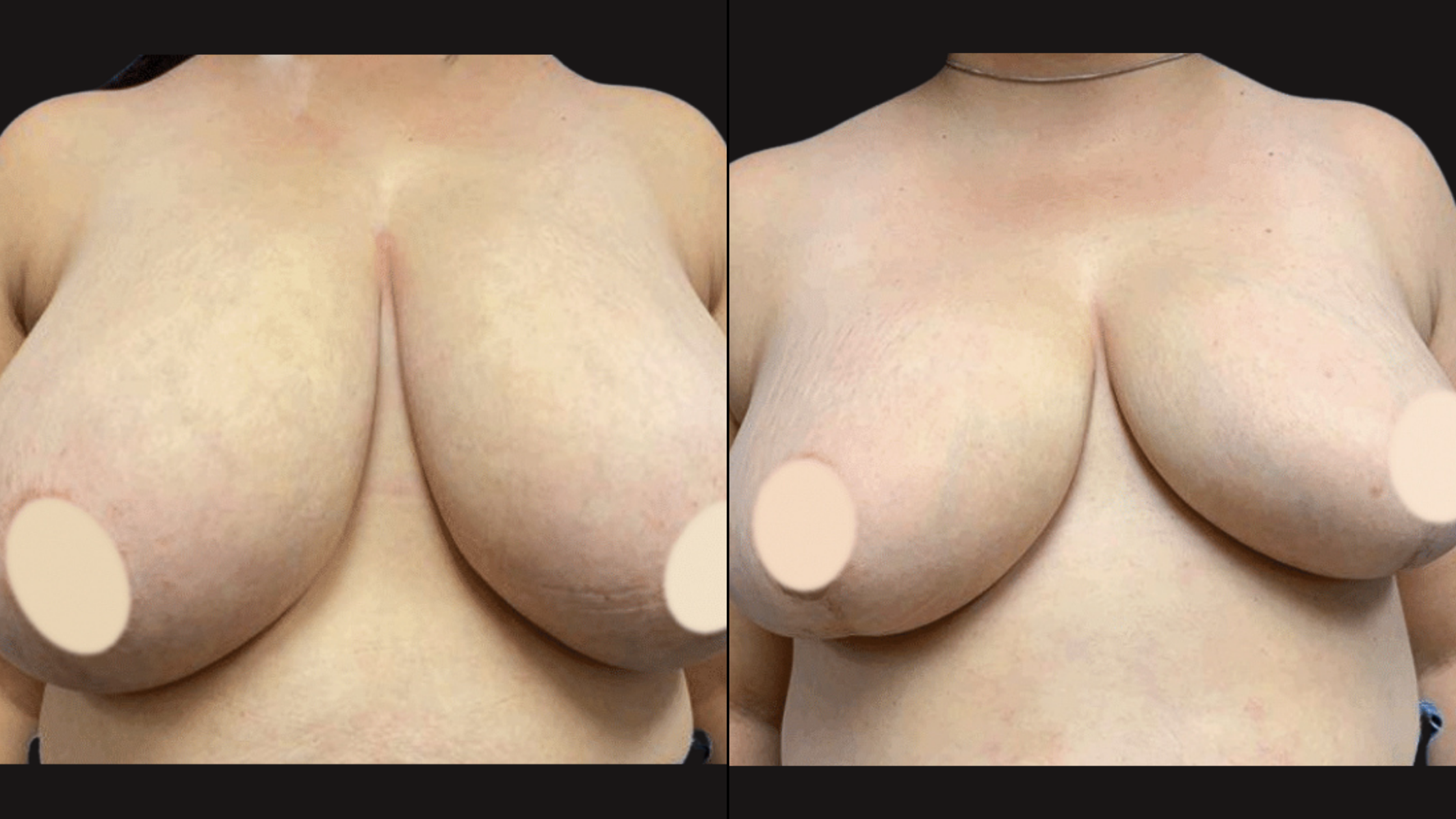 Comparison of a woman's bare chest before and after medical or cosmetic treatment, focusing on skin texture and appearance, against a black background.