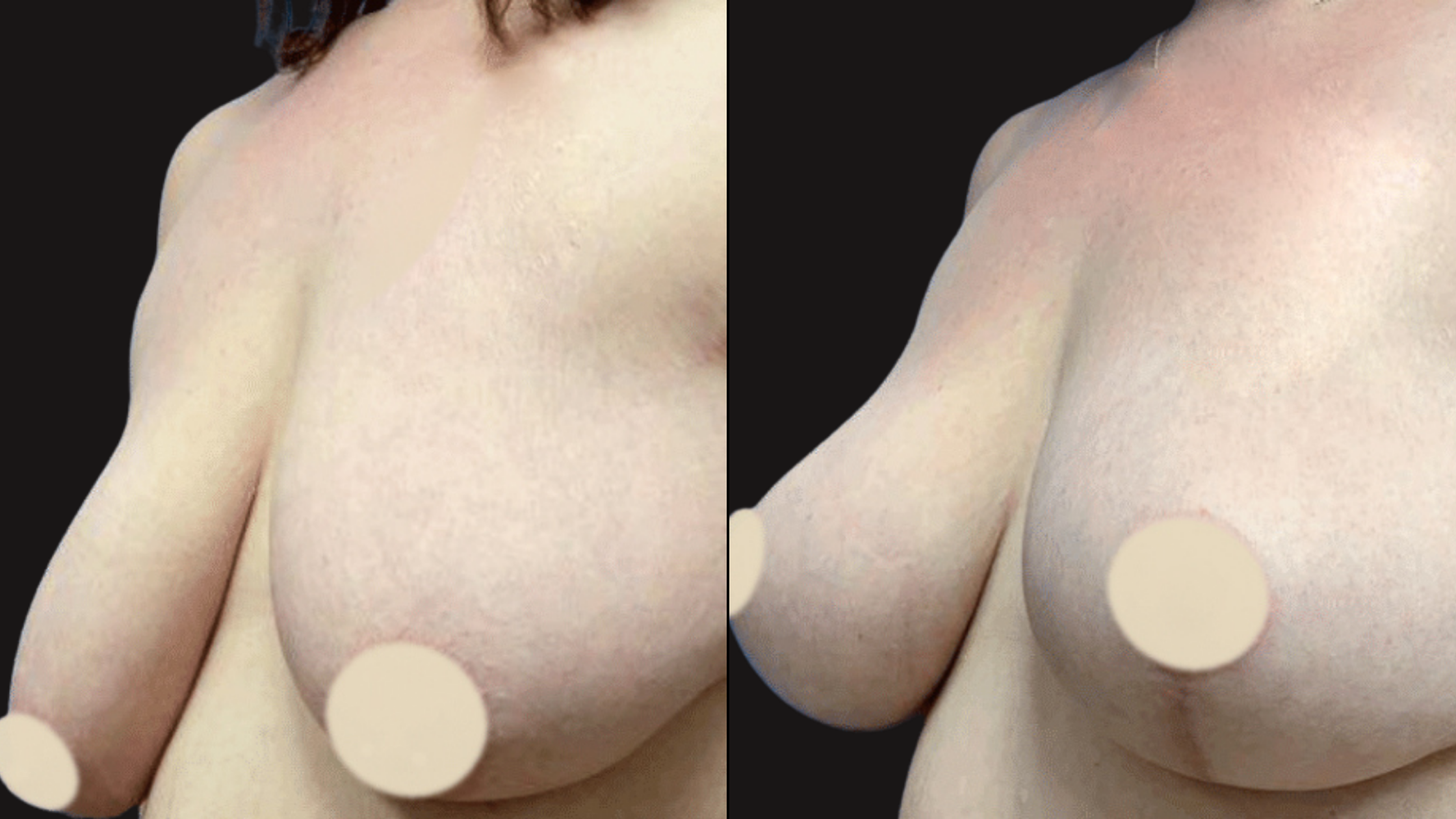 Close-up of a woman's shoulder and breast, with a black background.