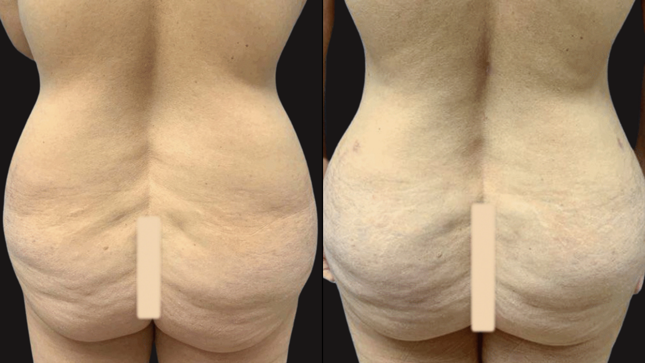Comparison of two images showing a person's lower back and buttocks, highlighting different skin textures with some cellulite.