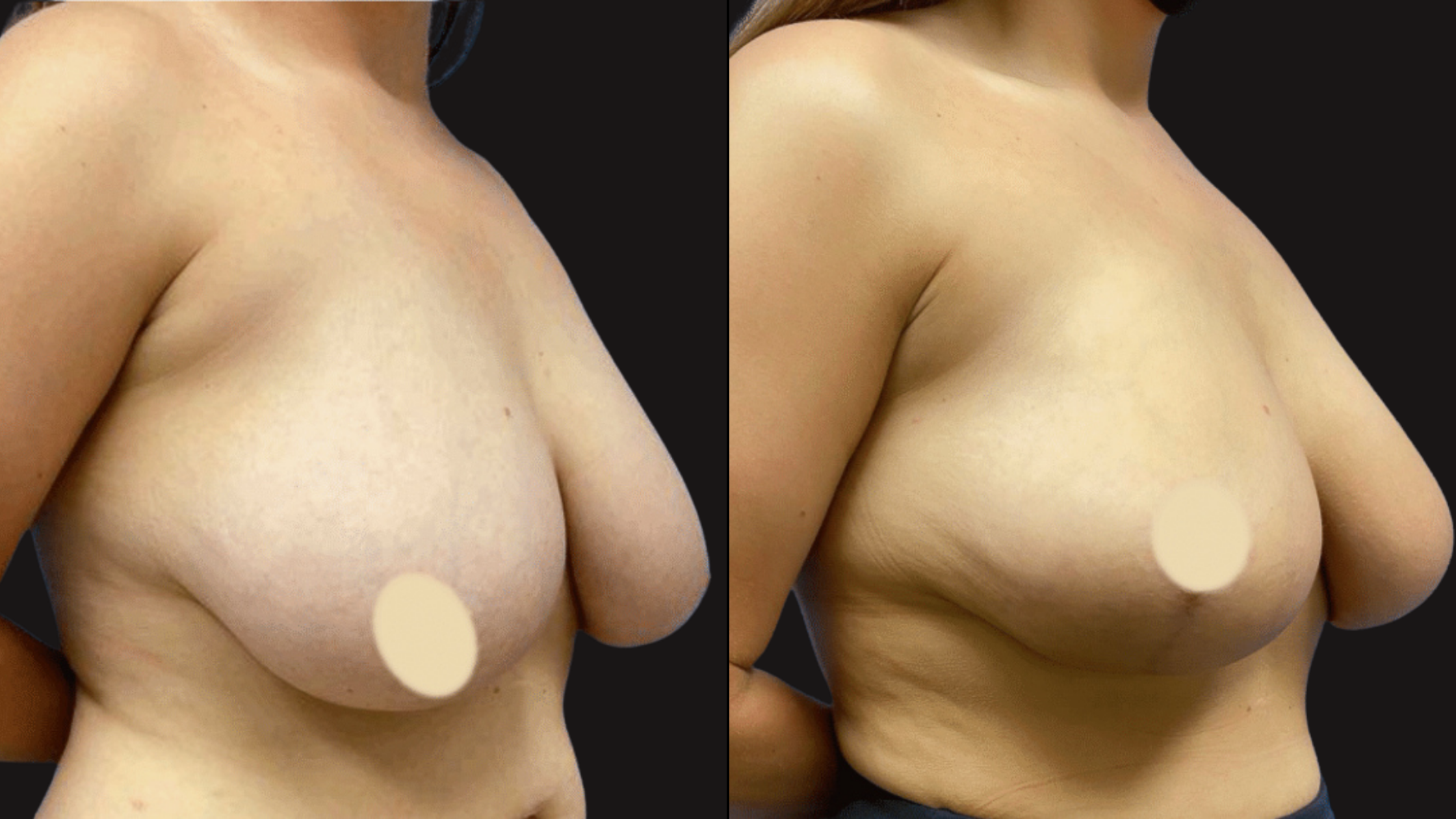 Side-by-side comparison of a woman's bare breasts, with a black background, showing before and after a cosmetic procedure.