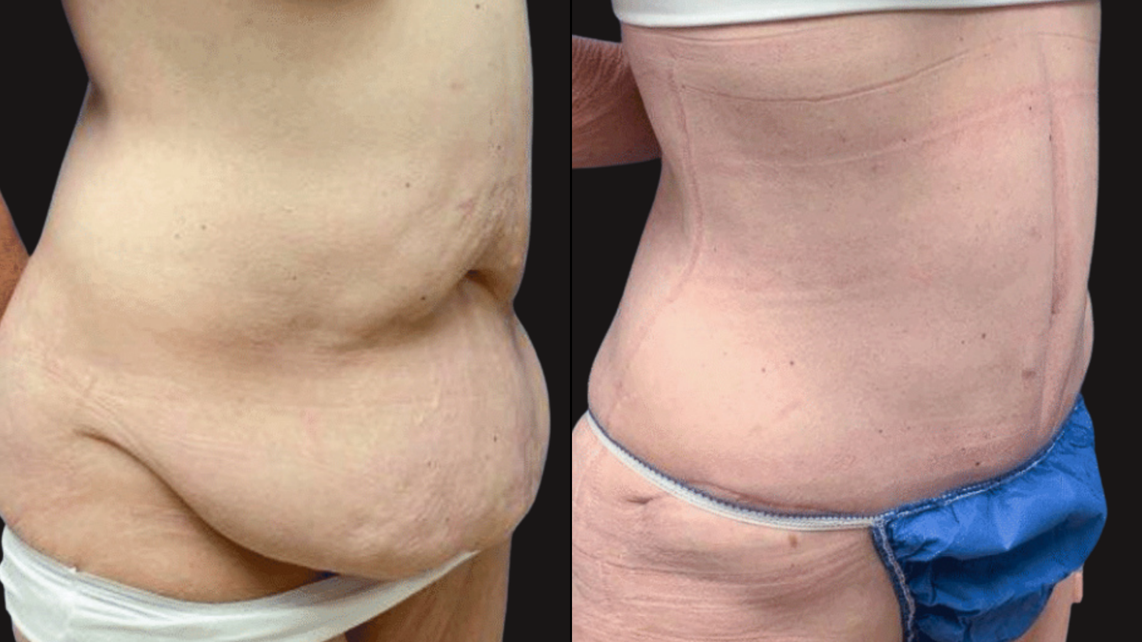 Comparison of a person's torso before and after weight loss or body transformation. The left side shows a larger abdomen with loose skin, while the right side shows a slimmer, more toned abdomen.