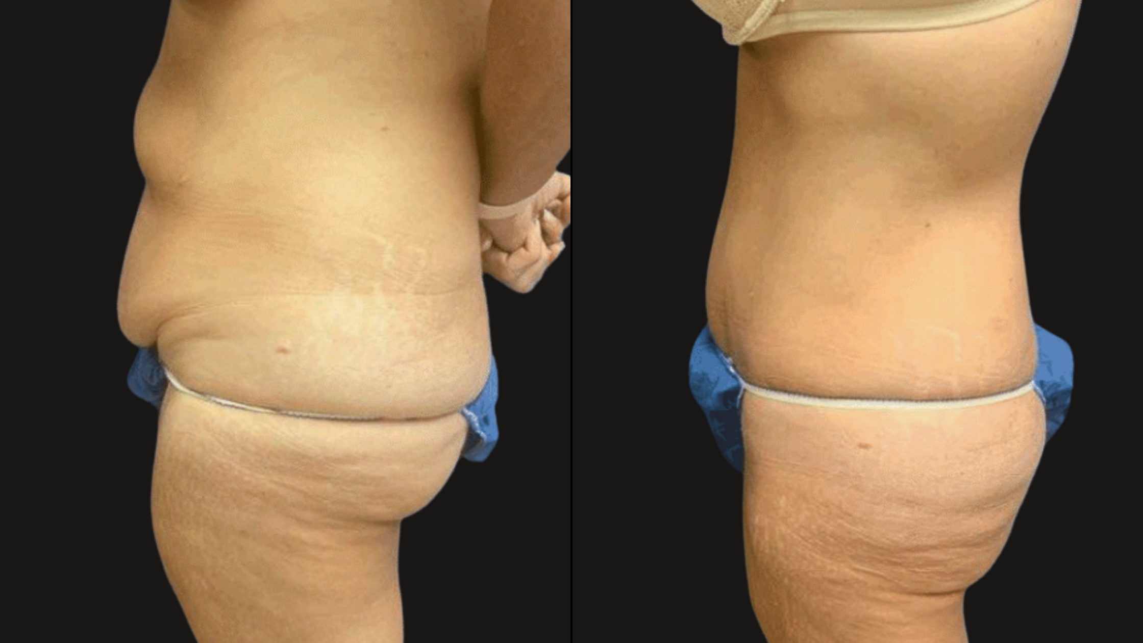 Side-by-side comparison of a person's torso and hips before and after weight loss, showing reduction in abdominal and waist fat.