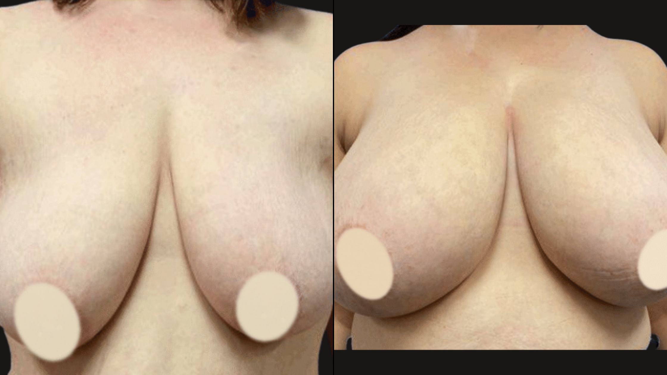 Close-up images of a woman's bare breasts with nipples covered by white circles. The image shows the front of her chest and upper torso against a black background.