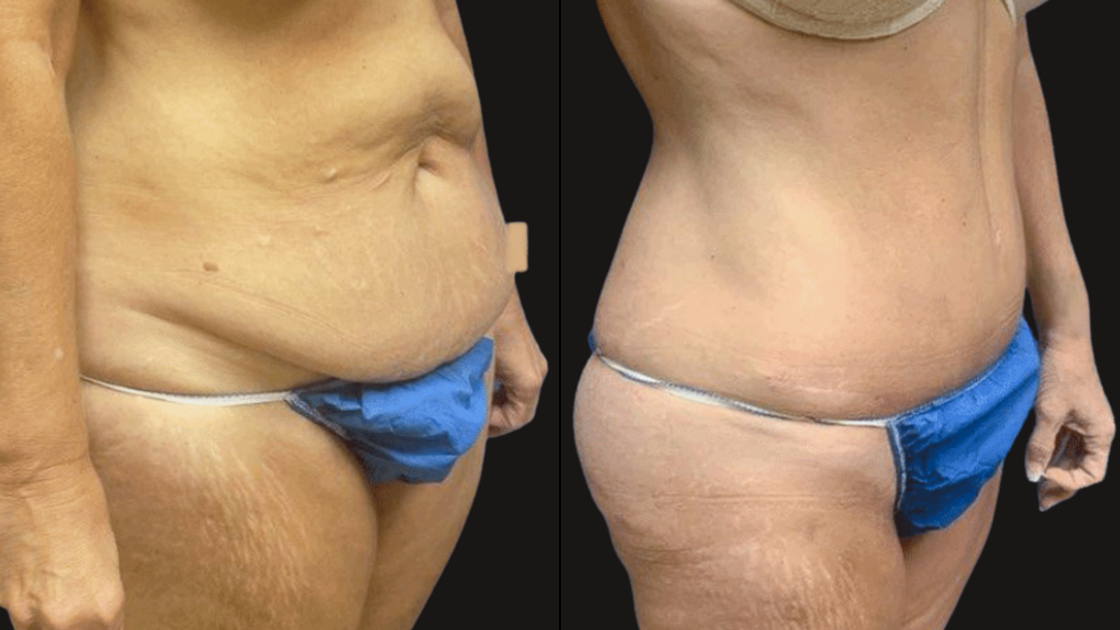 Side-by-side comparison of a person's lower torso before and after a body transformation, wearing blue underwear and a beige top.