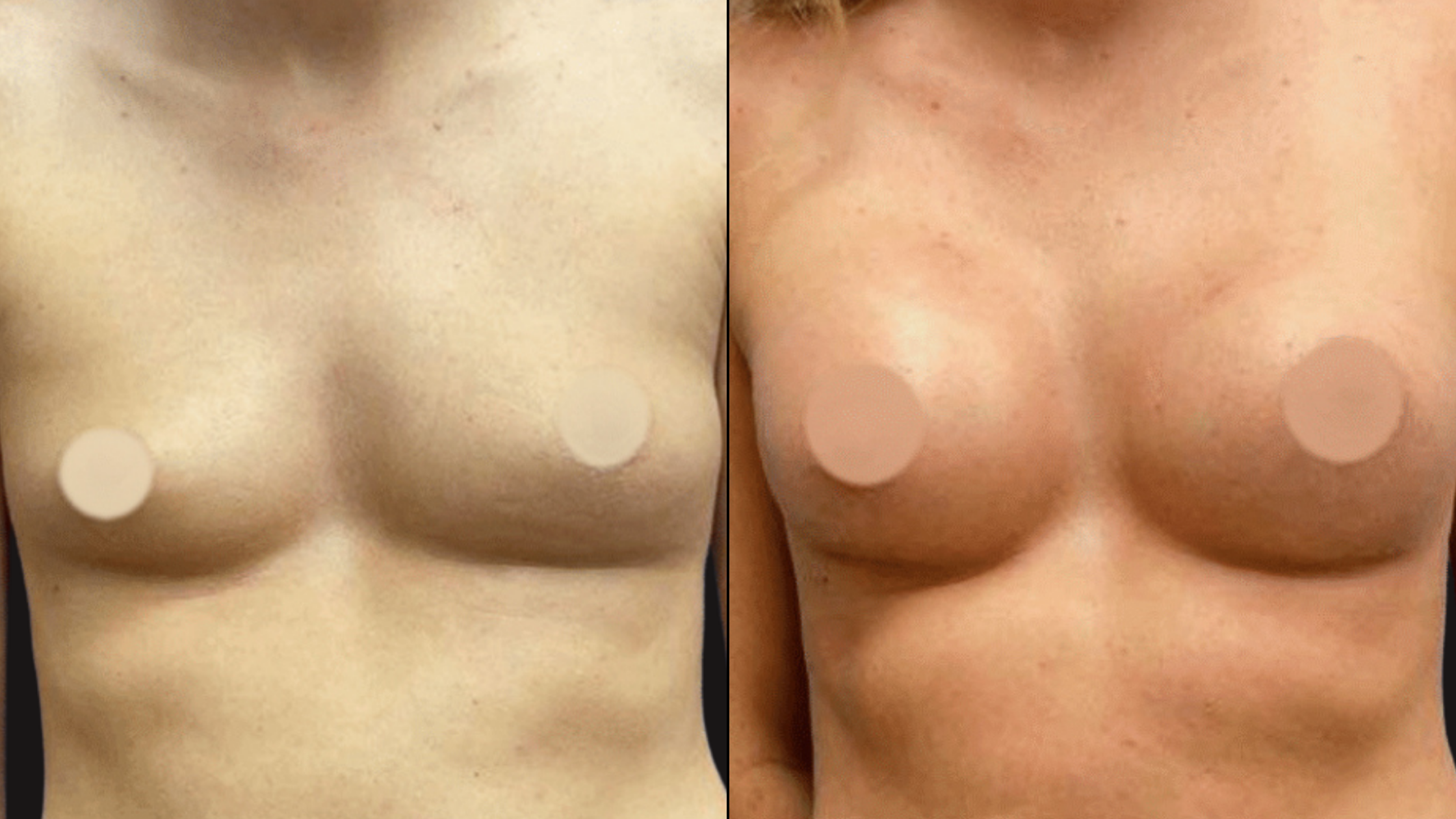 Comparison of two female torsos showing different skin tones and textures, with focus on bare breasts.