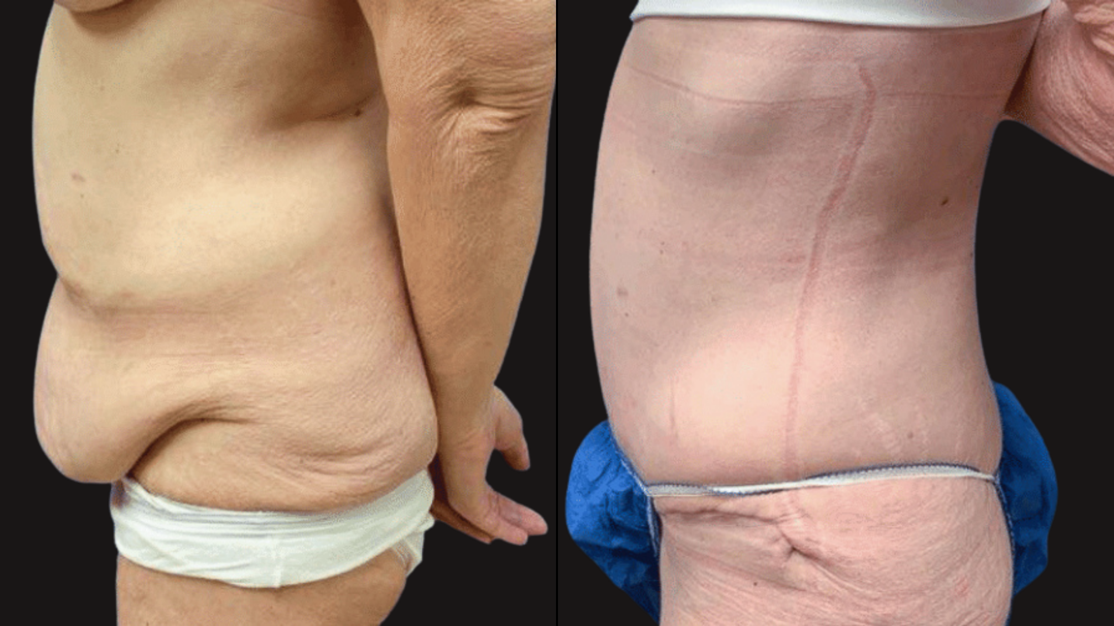 Side-by-side comparison of a person's torso before and after weight loss showing significant reduction in abdominal fat and loose skin.