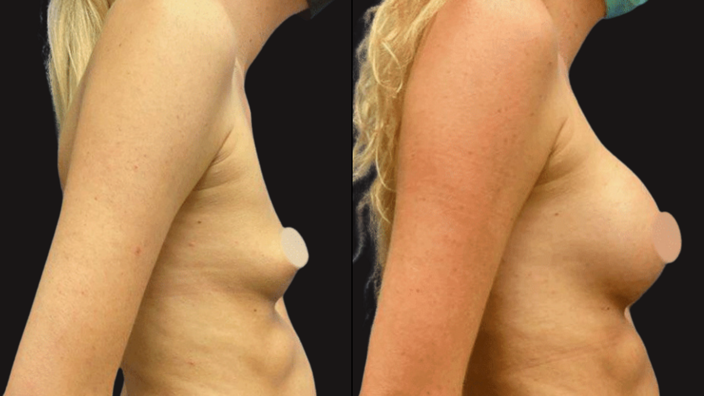 Side-by-side comparison of a woman's torso before and after a cosmetic procedure, showing changes in breast size and skin texture.