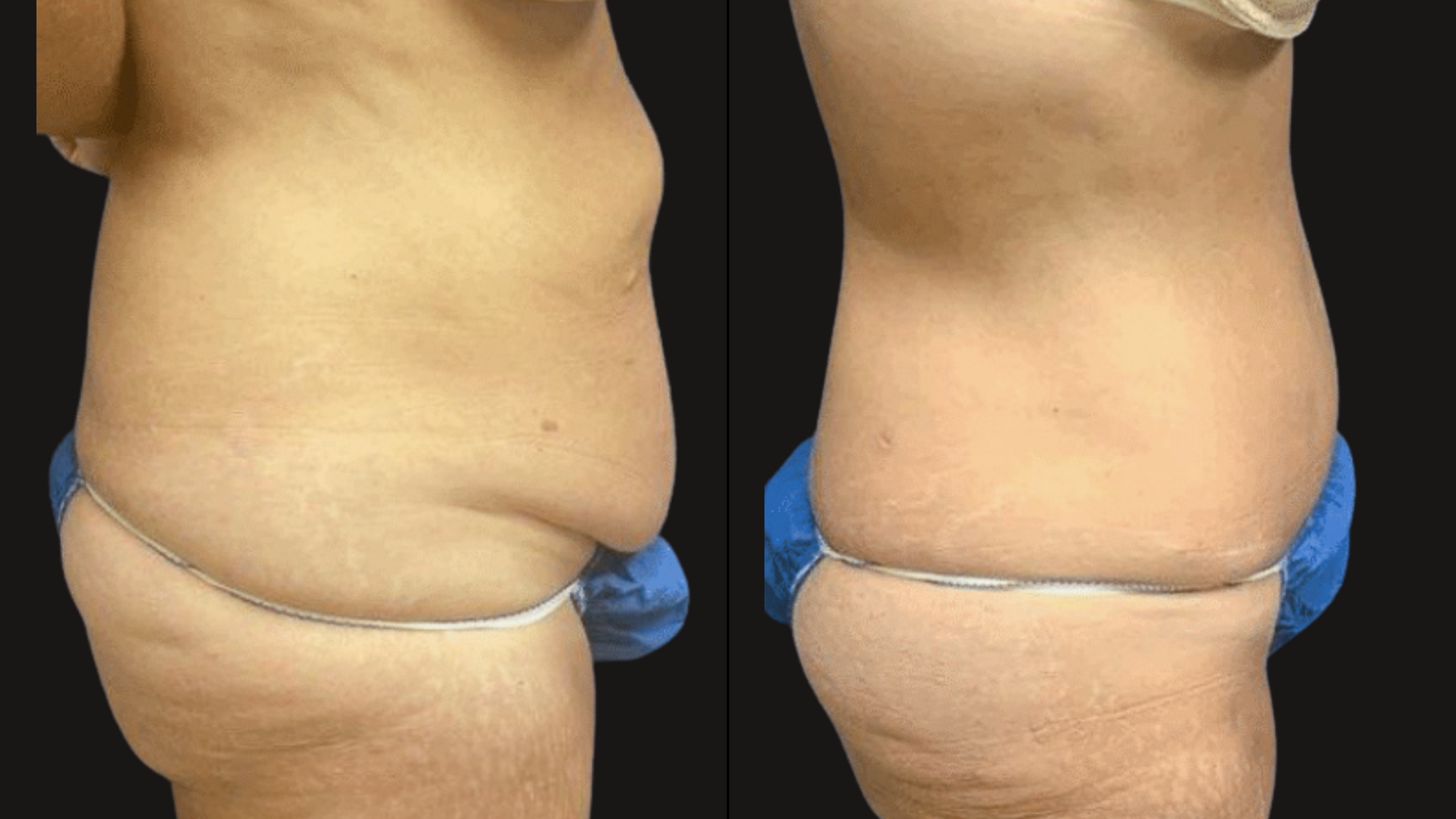 Side-by-side comparison of a person's midsection before and after body contouring, highlighting a reduction in abdominal size and skin tightening.