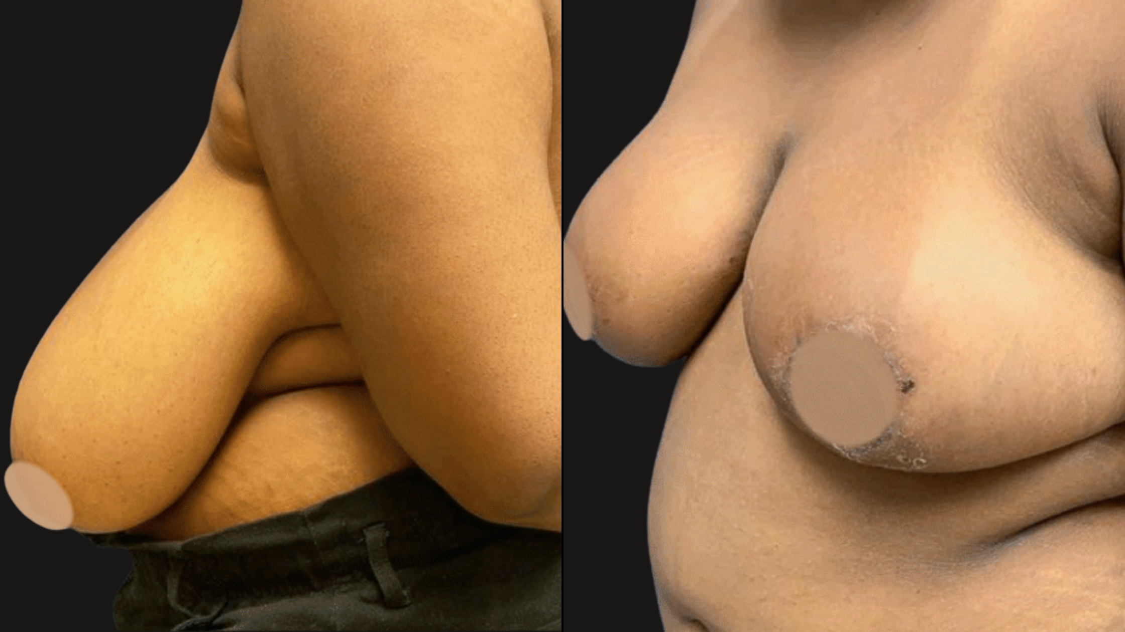 Close-up of a woman's nude body with focus on her chest and abdomen, blurred circles covering private areas on a dark background.