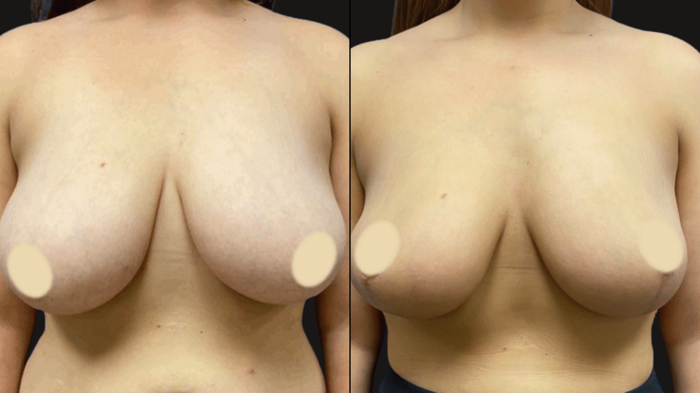 Comparison of a woman's chest before and after a cosmetic procedure, with the left side showing larger, fuller breasts and the right side showing smaller breasts.