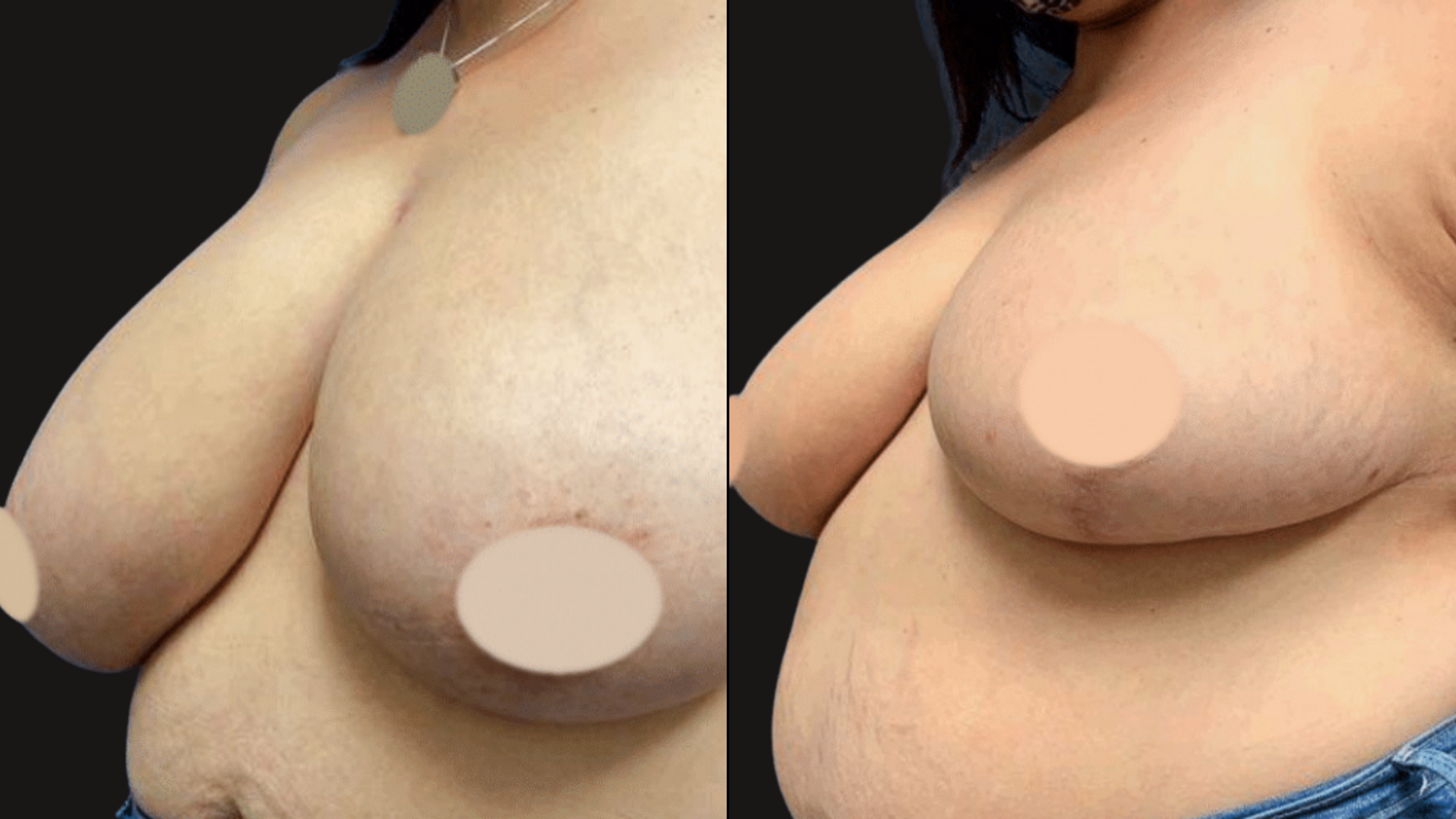 Side-by-side comparison of a woman's upper torso, focusing on her breasts. The left side shows a digital illustration or painting, and the right side shows a real photograph. Both images have patches covering parts of the nipples.