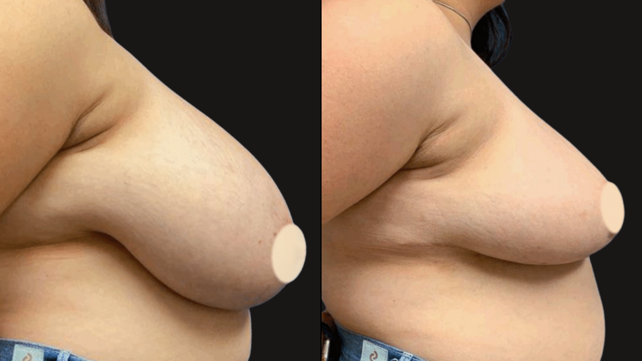 Close-up comparison of two breasts, showing a before and after breast augmentation or enhancement.