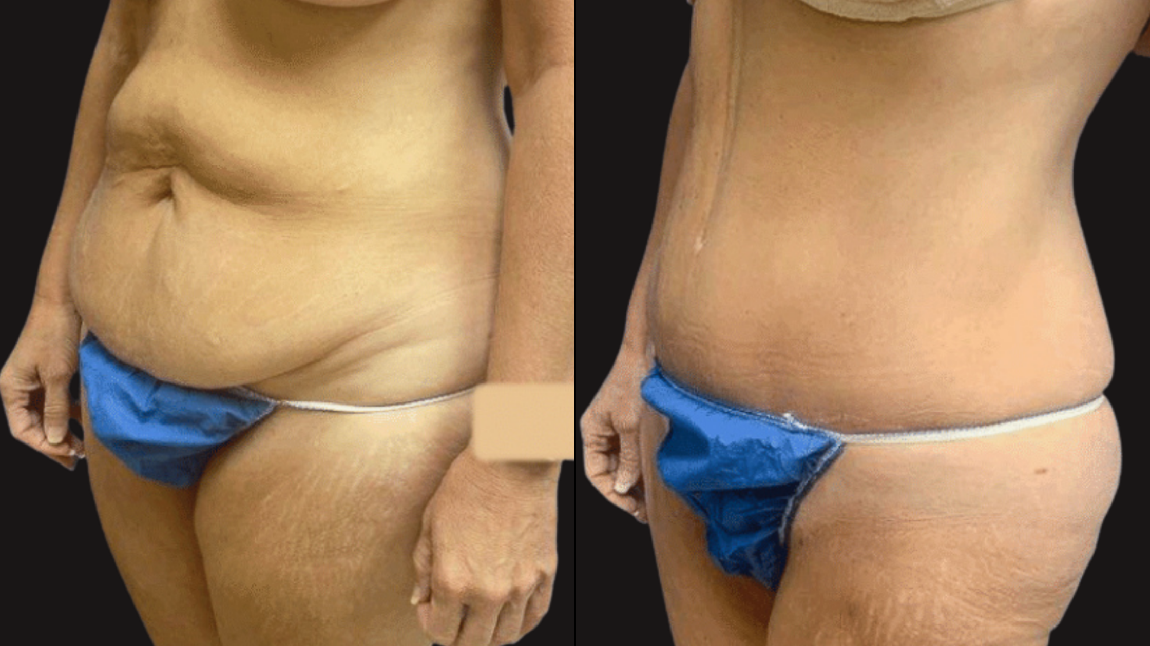 Side-by-side comparison of a person's abdomen and waist before and after a skin-tightening treatment, wearing blue underwear.