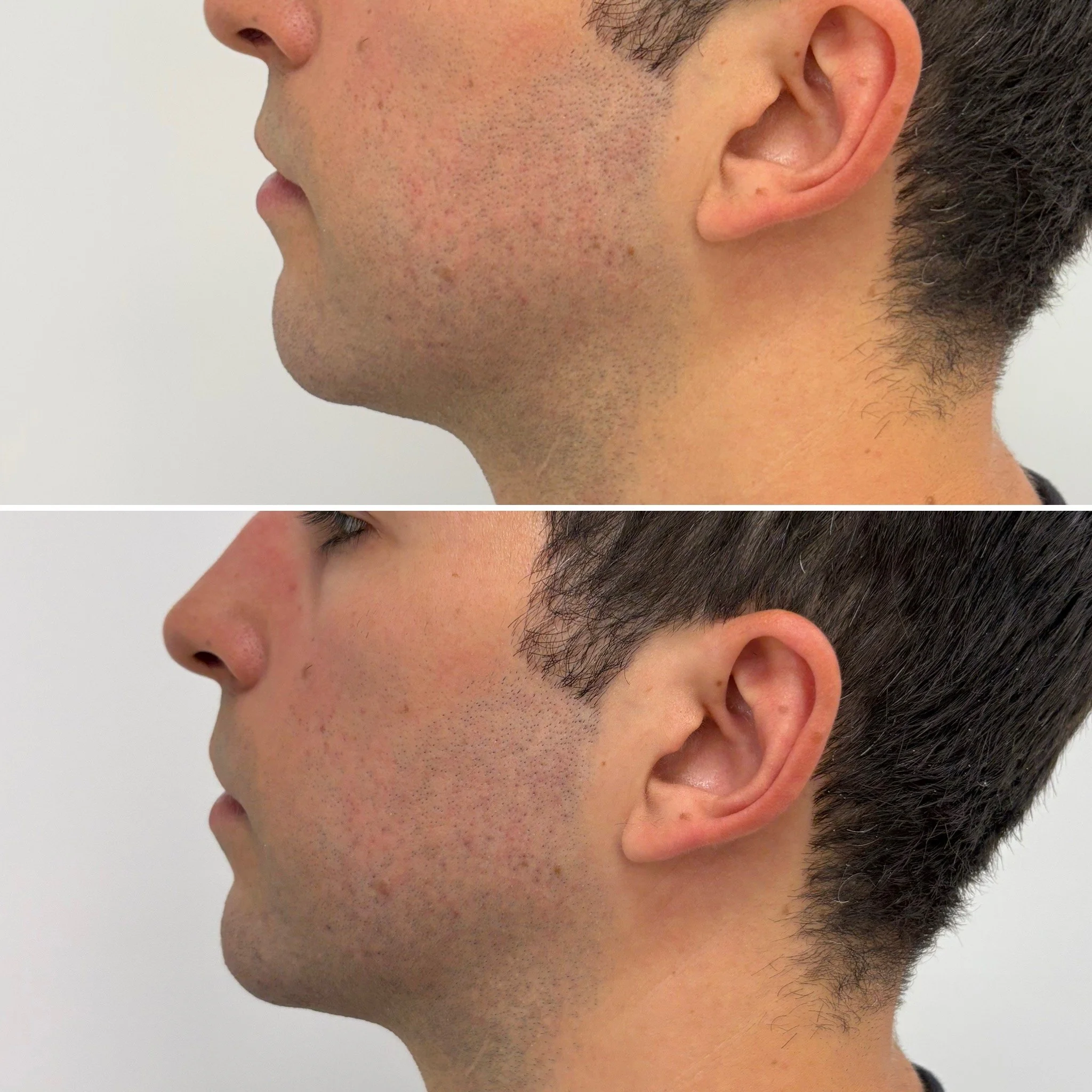 Deux images côte à côte montrant un profil d'homme, avec des différences visibles dans la peau, notamment une amélioration de la texture de la peau dans la seconde image.