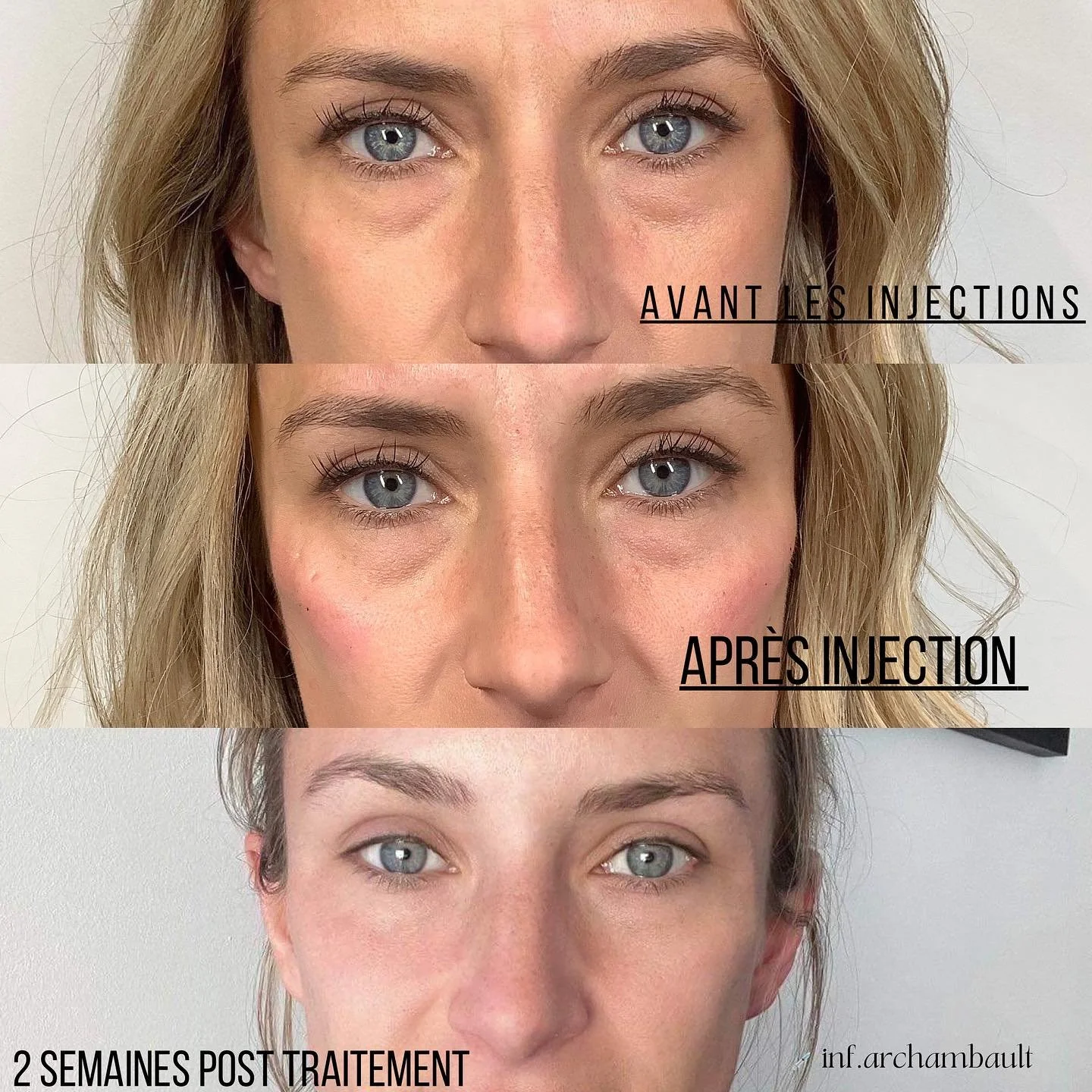 Comparaison du visage d'une femme avant, après injection et deux semaines après traitement. La première image montre un visage avec des rides sous les yeux, la deuxième image montre une réduction de ces rides après injection, et la troisième image mo