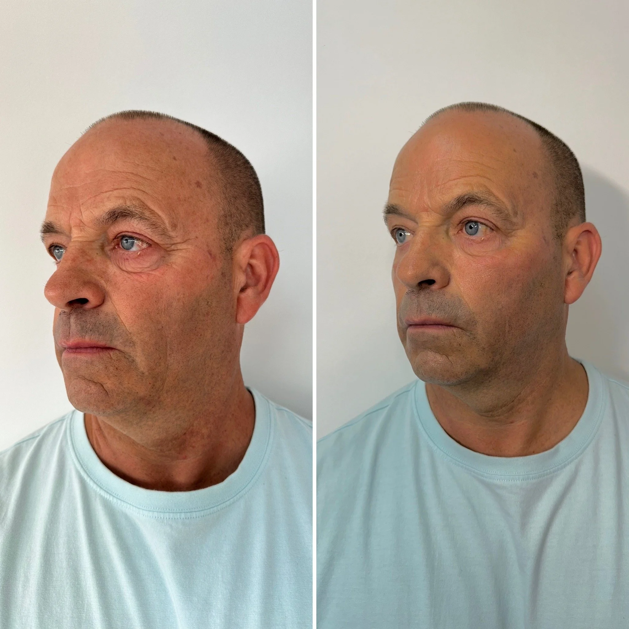 Deux images d'un homme vu de profil, avec une expression sérieuse, portant un t-shirt bleu clair, contre un fond blanc, avec des différences visibles dans la peau et la tête entre les deux photos.