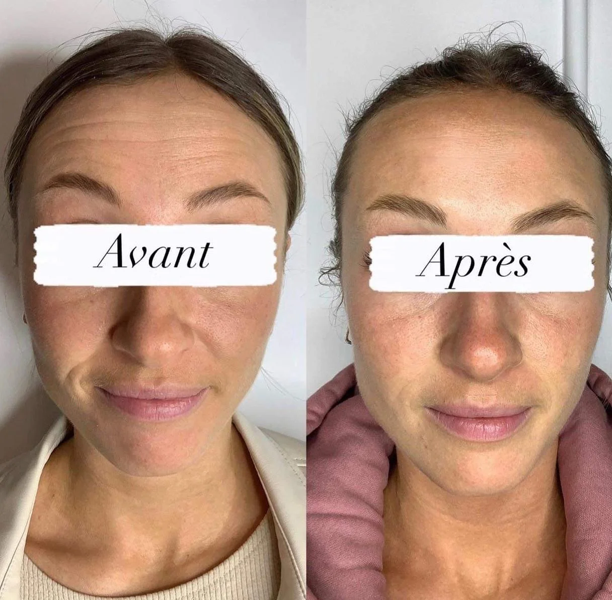 Comparaison visage d'une femme avant et après un traitement facial, montrant une peau plus claire et moins rouge dans la photo après.