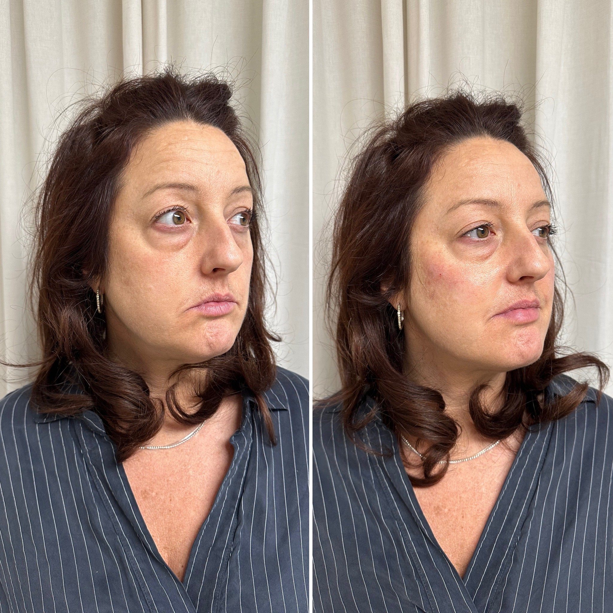 Comparaison de deux photos d'une femme montrant les effets du maquillage ou d'un traitement facial, avec réduction des poches et des rougeurs sur la droite.