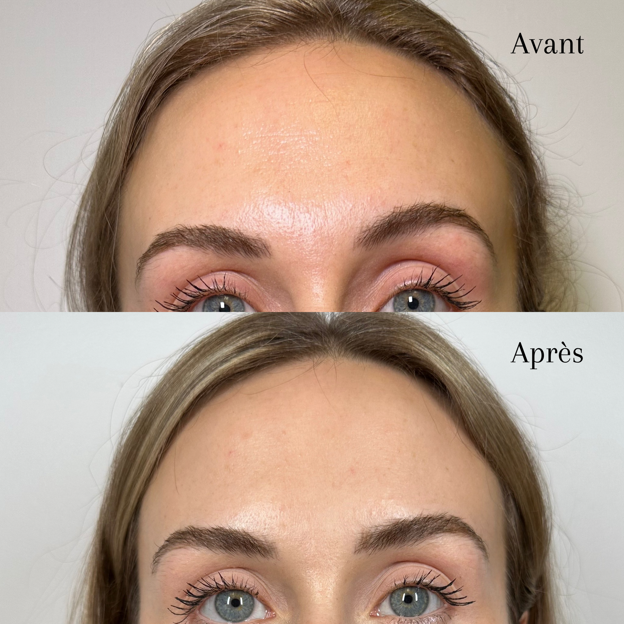 Comparaison du visage d'une femme avant et après une intervention cosmétique, montrant une peau plus lisse et des sourcils plus définis.
