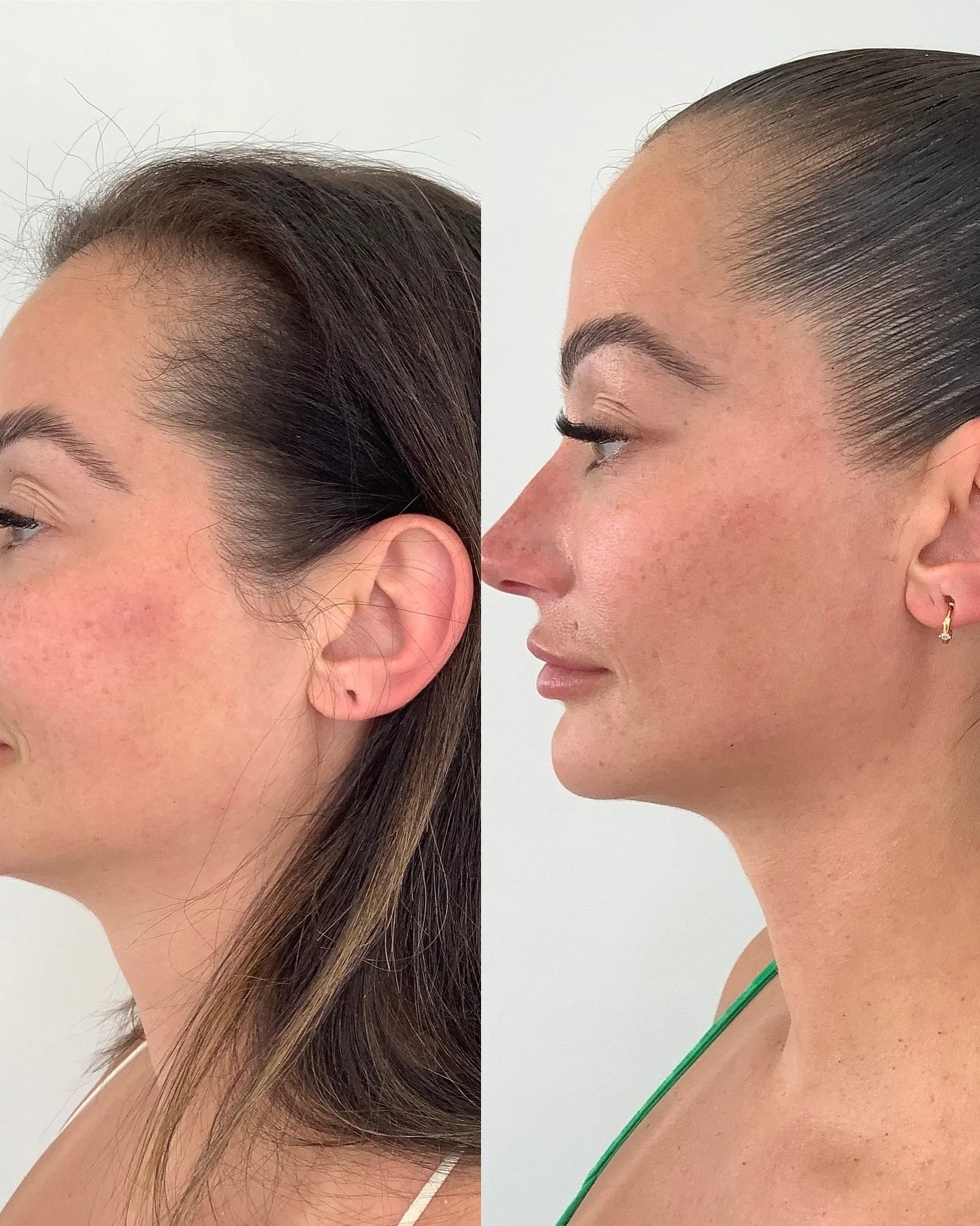 Comparaison du profil d'une femme avant et après une intervention ou un traitement de la peau et des cheveux, avec des changements visibles de la texture de la peau et de la coiffure.