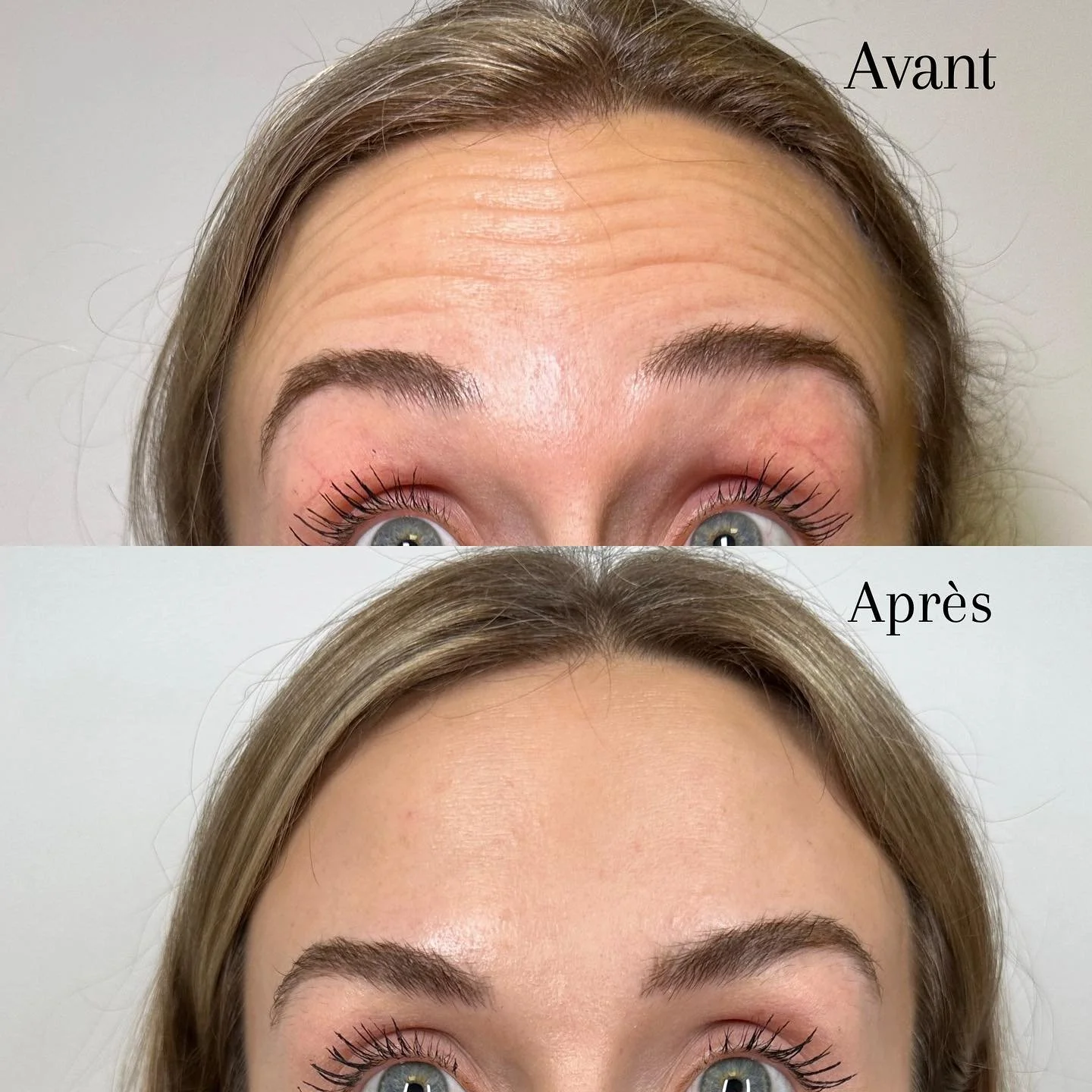 Photo comparative de la même personne avant et après une procédure de maquillage ou de soins, montrant un front avec des rides plus visibles dans la photo 'Avant' et une peau plus lisse et sans rides dans la photo 'Après'.