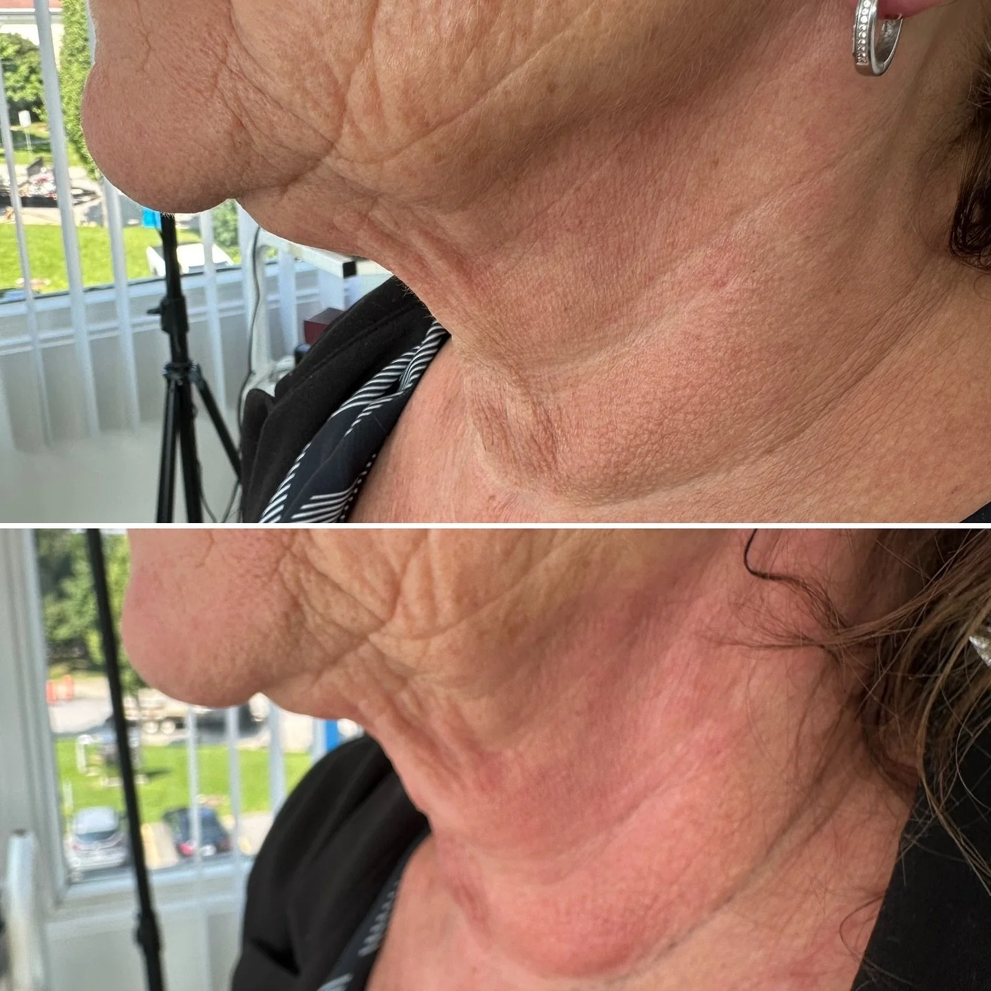 Comparaison des zones du cou et de la mâchoire d'une femme, montrant une amélioration après un traitement, en raison d'une réduction de la peau lâche et des rides.