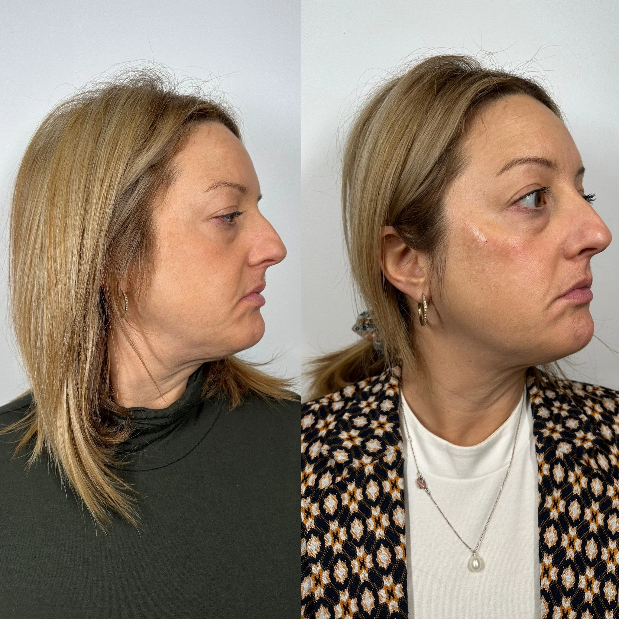 Comparaison avant et après traitement de la peau d'une femme, montrant une amélioration visible de la peau et du maquillage après traitement.