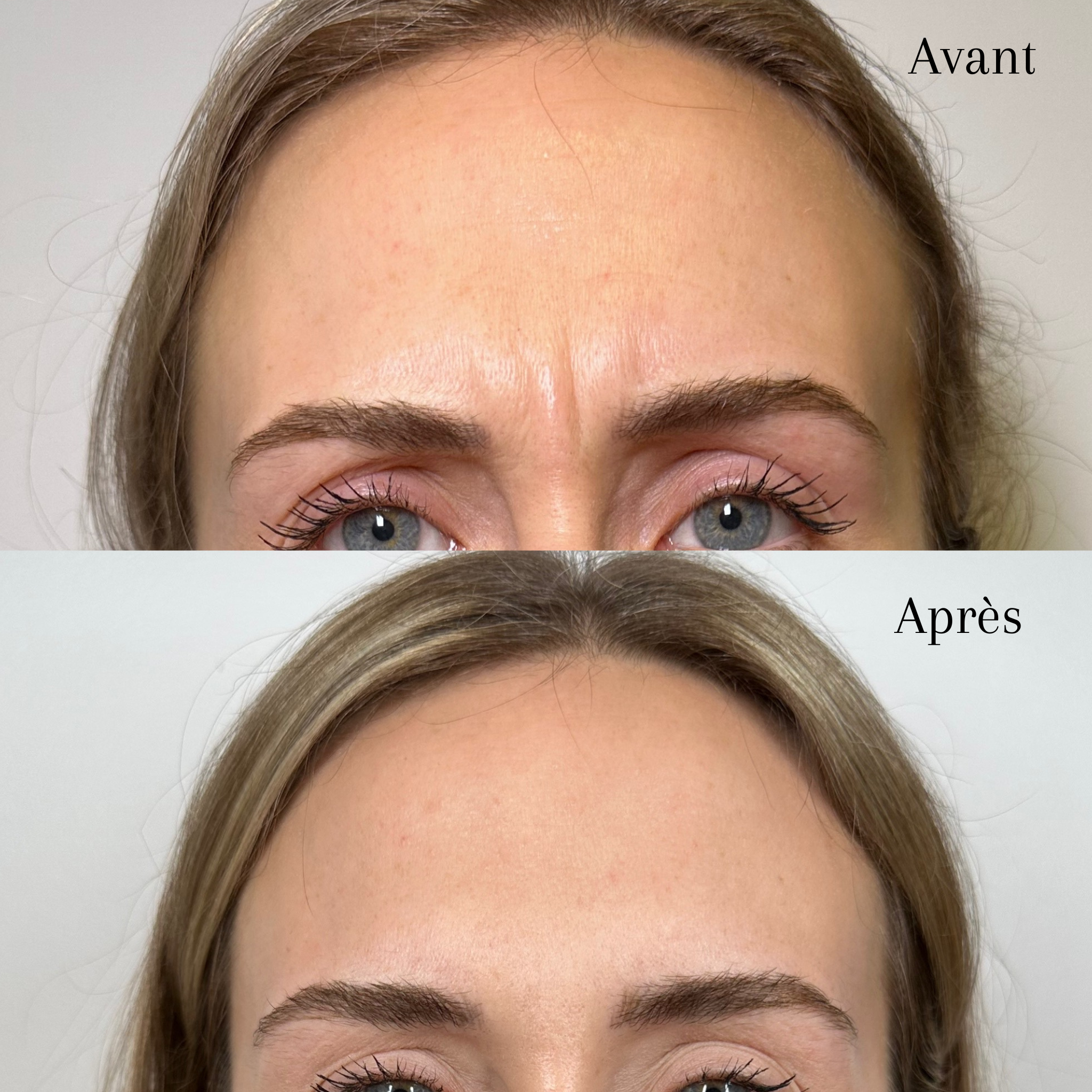Avant : visage féminin avec rides et peau ridée sur le front. Après : même visage avec peau plus lisse et sans rides visibles.
